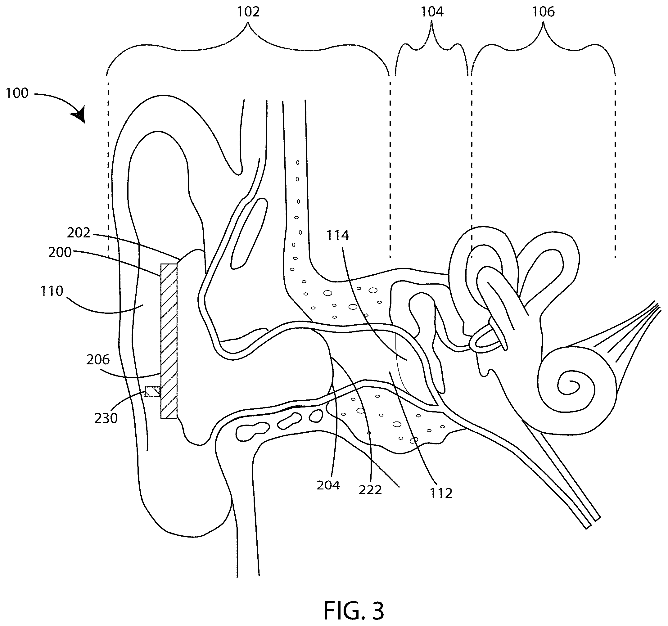 Patent US11785403 Figure 3 – Device to optically verify custom hearing aid fit and method of use