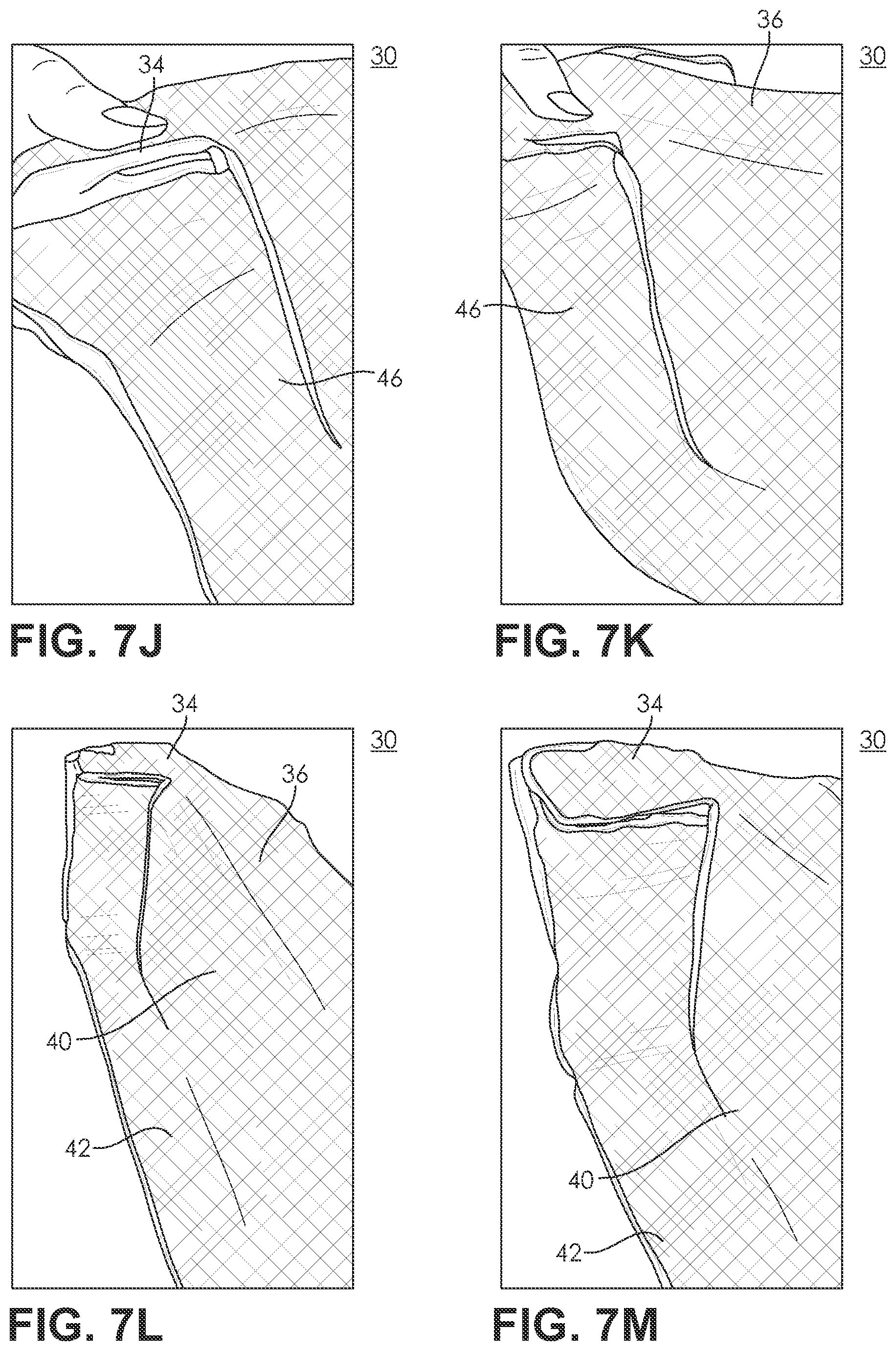 Patent US11787087 Figure 10 – Three dimensional preform created by preconsolidation of thermal plastic stitched sheet