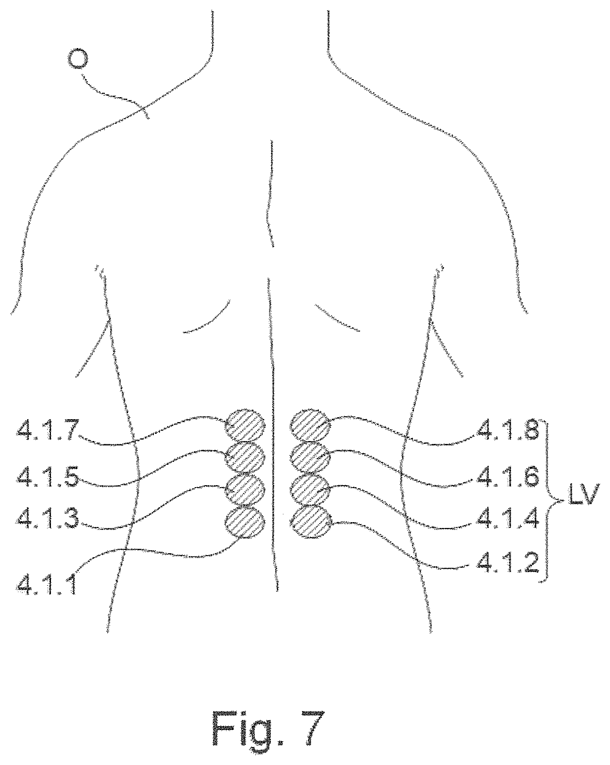 Patent US11787319 Figure 4 – Apparatus for a seat, more particularly a vehicle seat, for mobilizing at least one region of a spinal column of a seat occupant, method for sequentially driving an apparatus and seat, more particularly vehicle seat