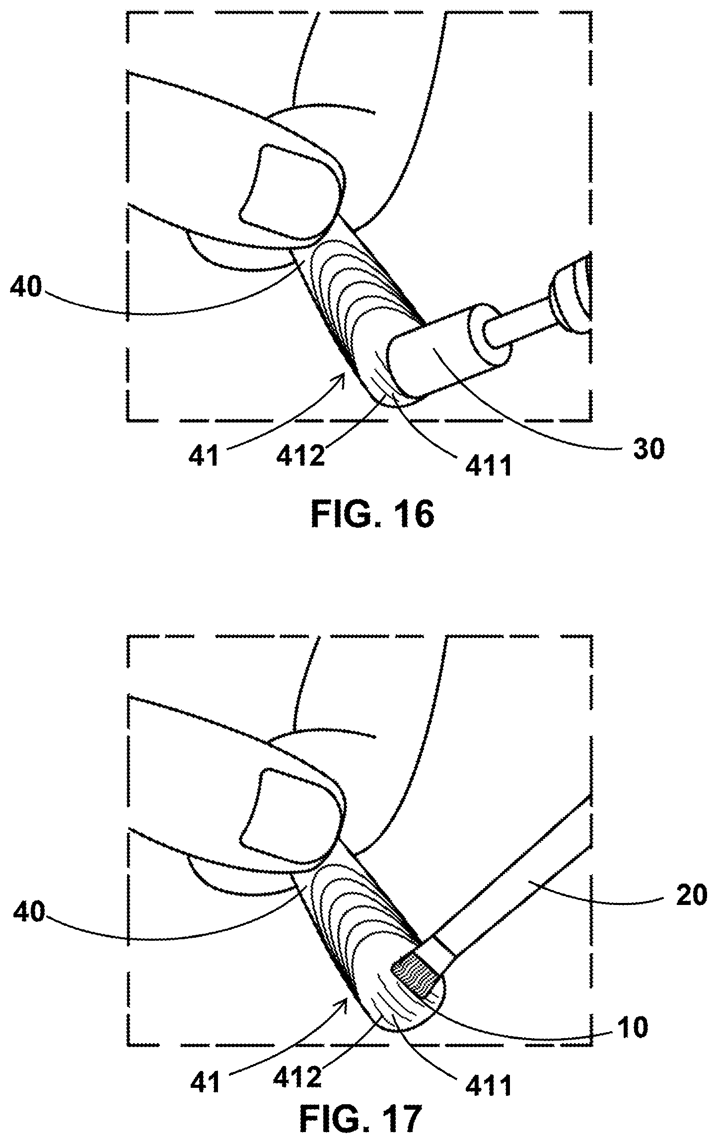 Patent US11793289 Figure 11 – Artificial nail tip and curing composition set and applying method thereof