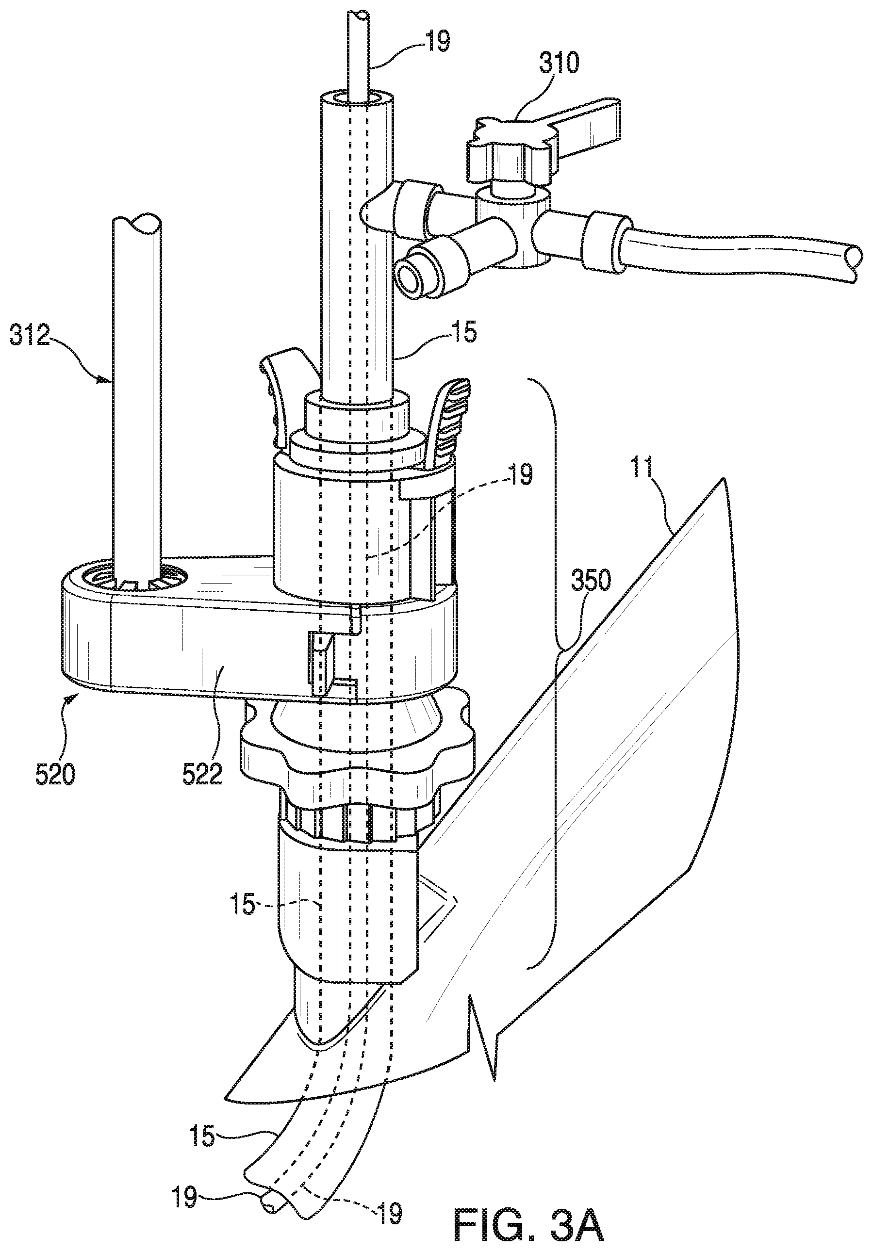 Patent US11793395 Figure 5 – Surgical system having a guide catheter including a fluid passageway
