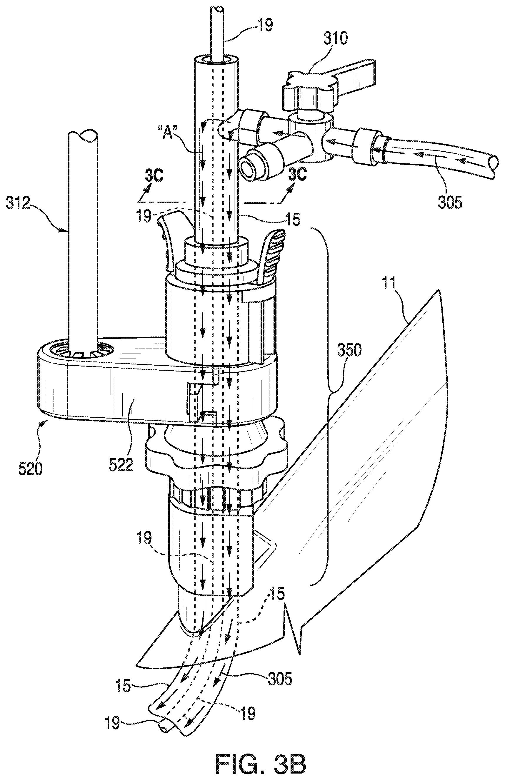 Patent US11793395 Figure 6 – Surgical system having a guide catheter including a fluid passageway