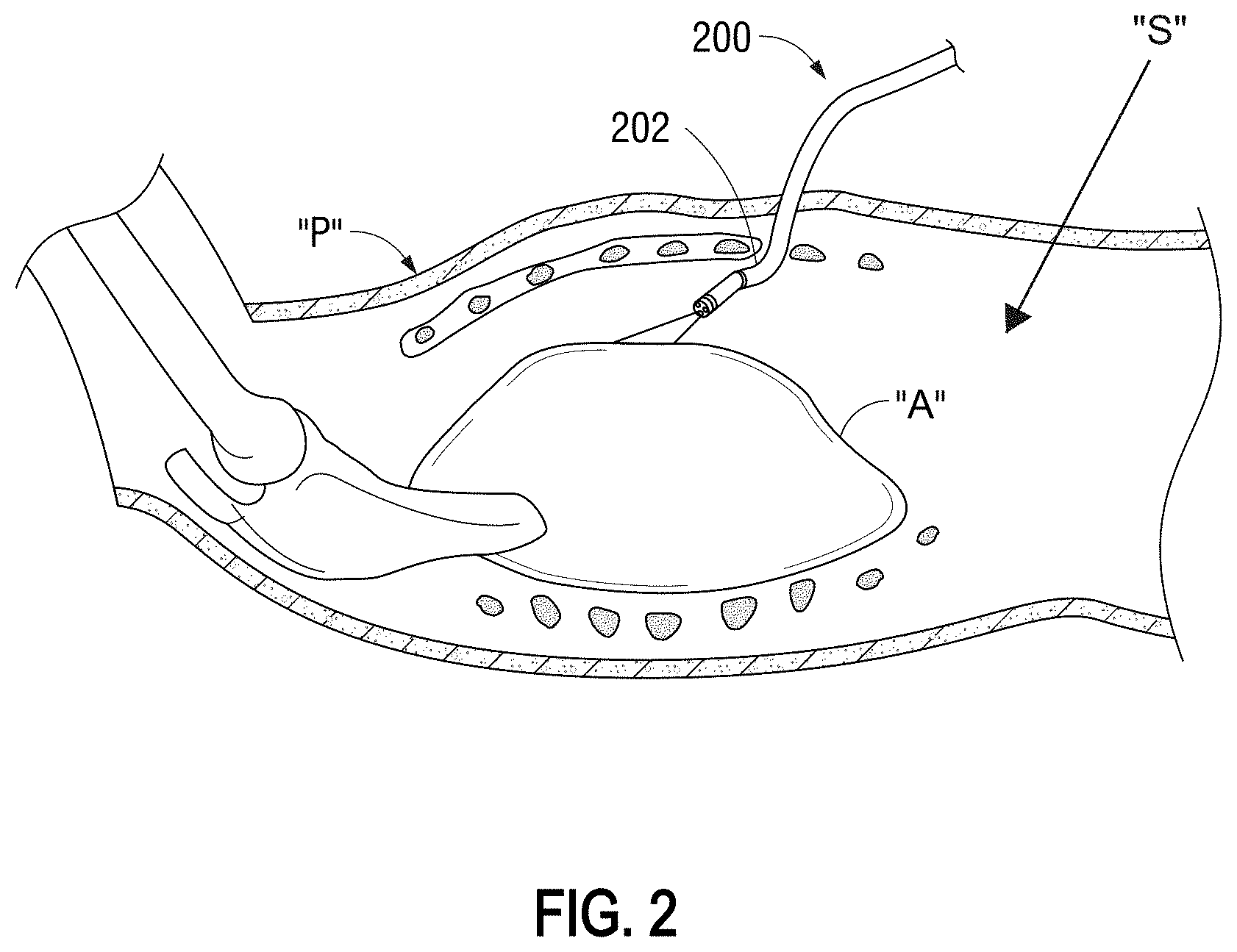 Patent US11793402 Figure 2 – System and method for generating a three-dimensional model of a surgical site