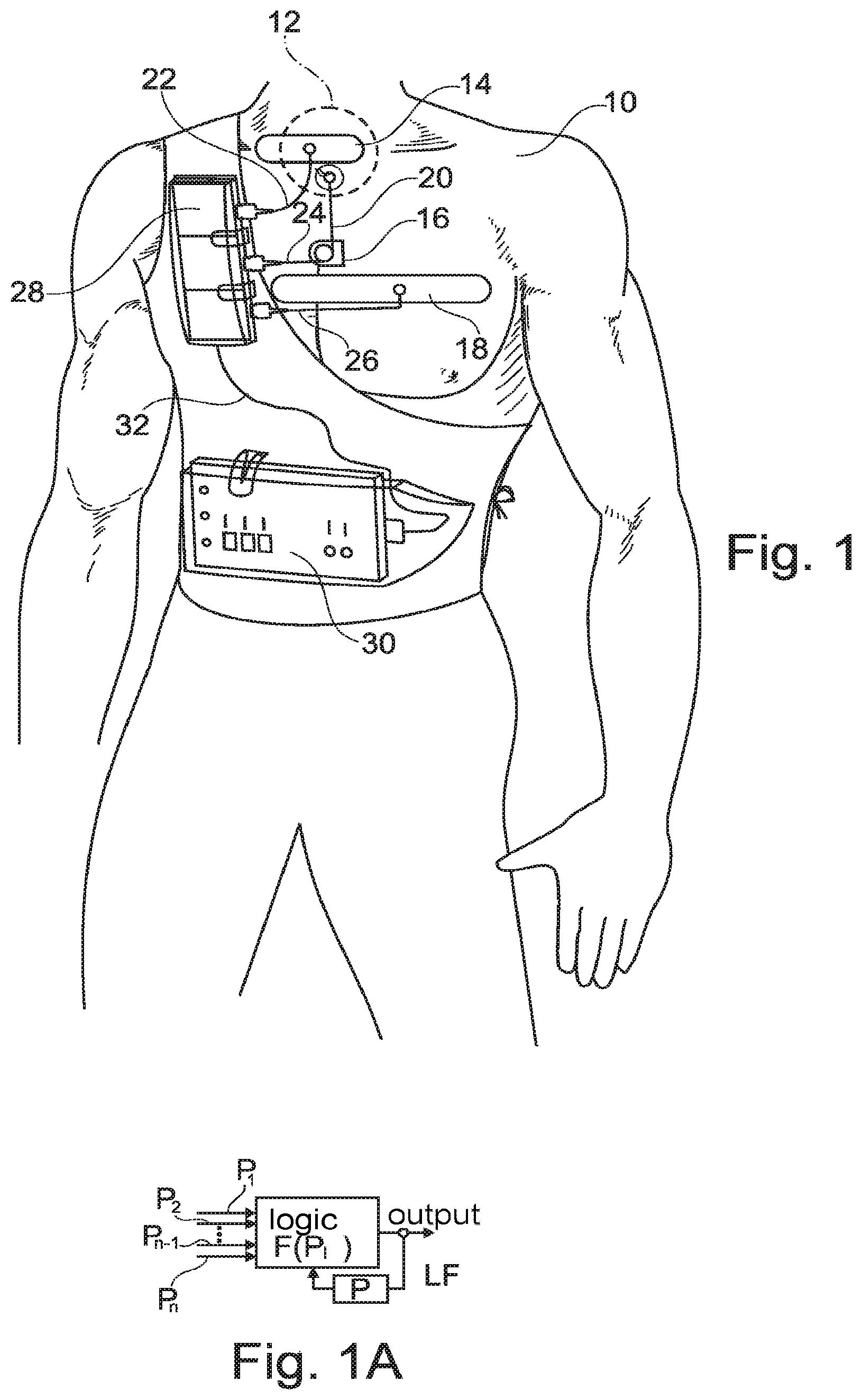 Patent US11793409 Figure 1 – System for the early detection of postoperative bleeding