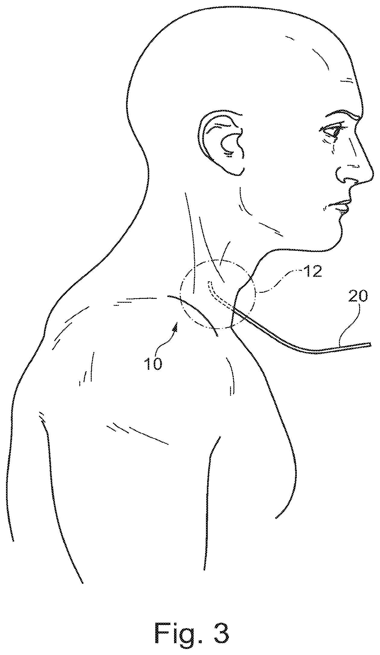 Patent US11793409 Figure 3 – System for the early detection of postoperative bleeding