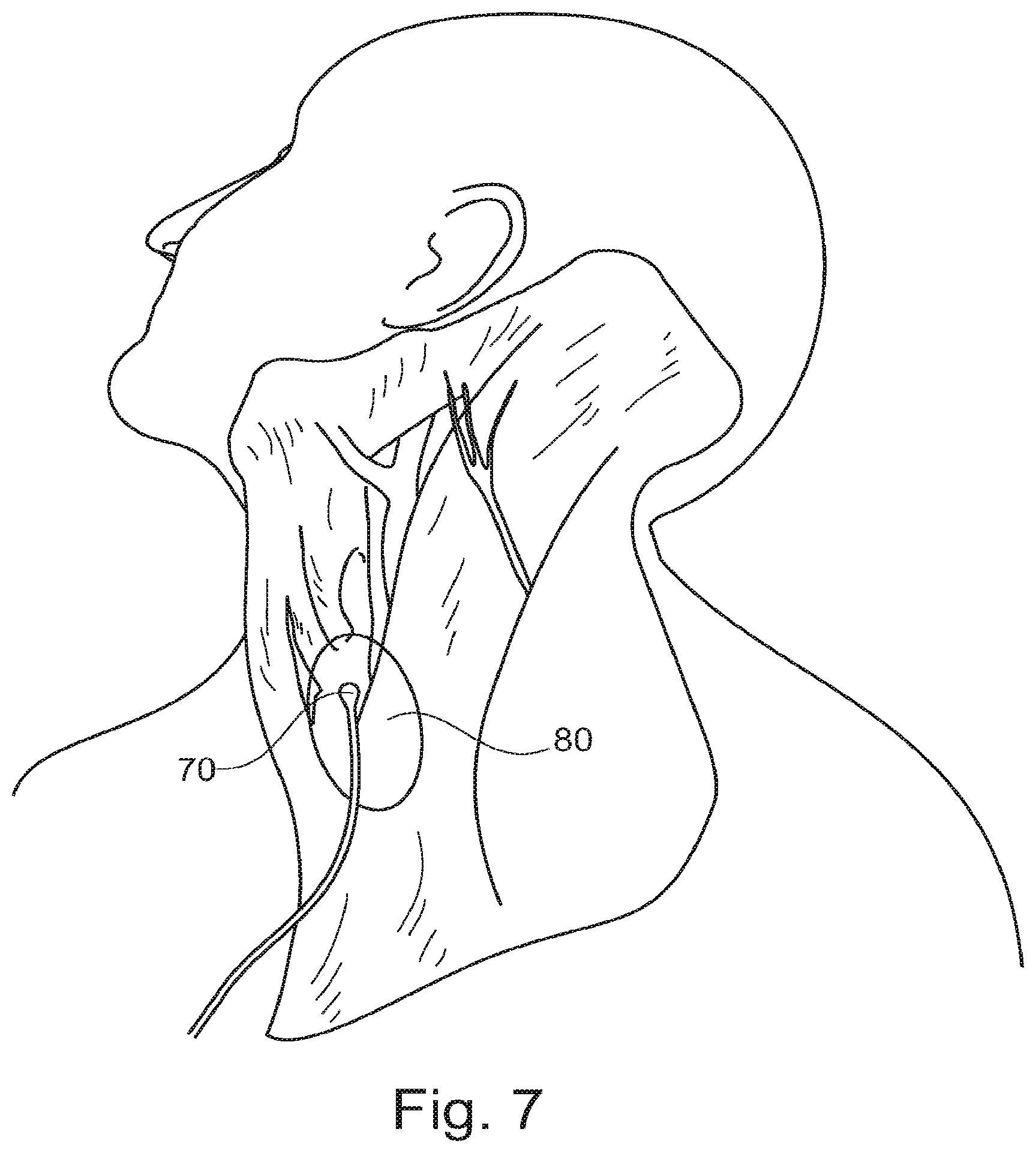 Patent US11793409 Figure 8 – System for the early detection of postoperative bleeding