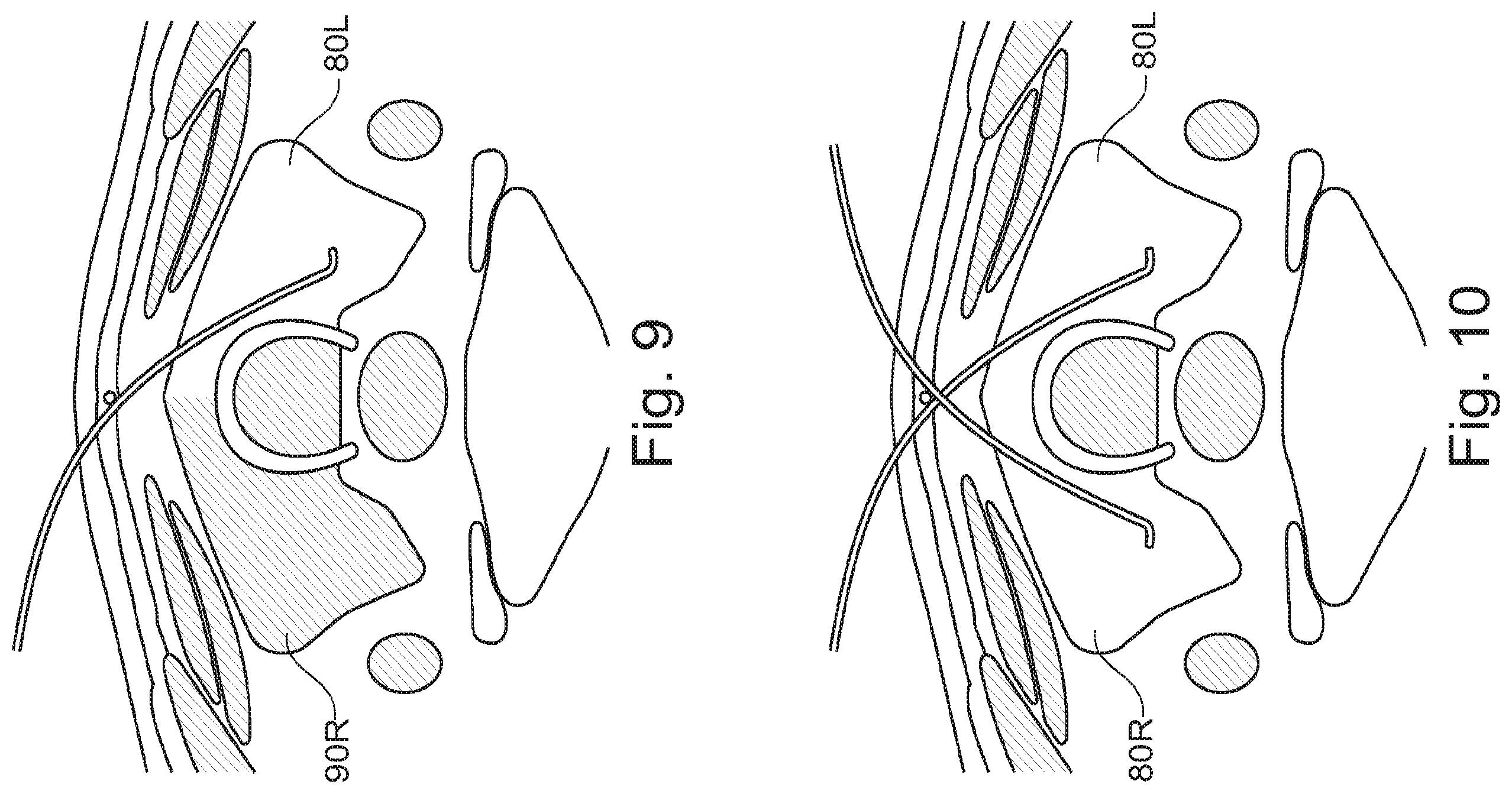 Patent US11793409 Figure 10 – System for the early detection of postoperative bleeding