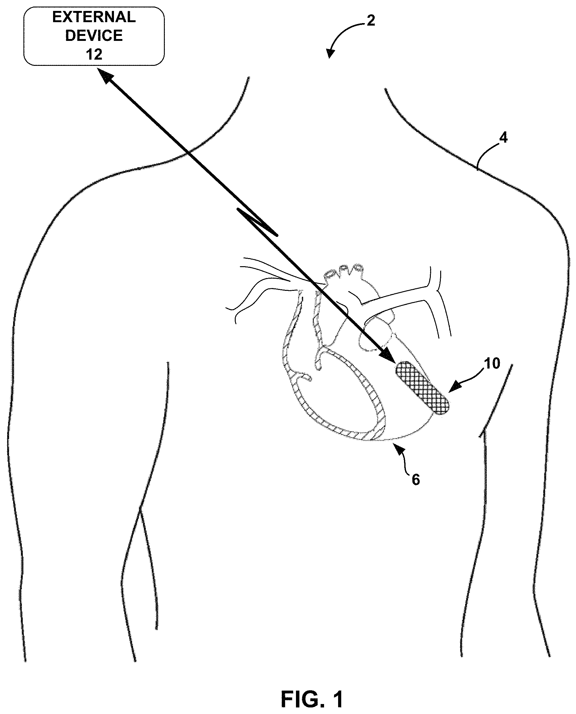 Patent US11793411 — Sensing for heart failure management — Figure 1