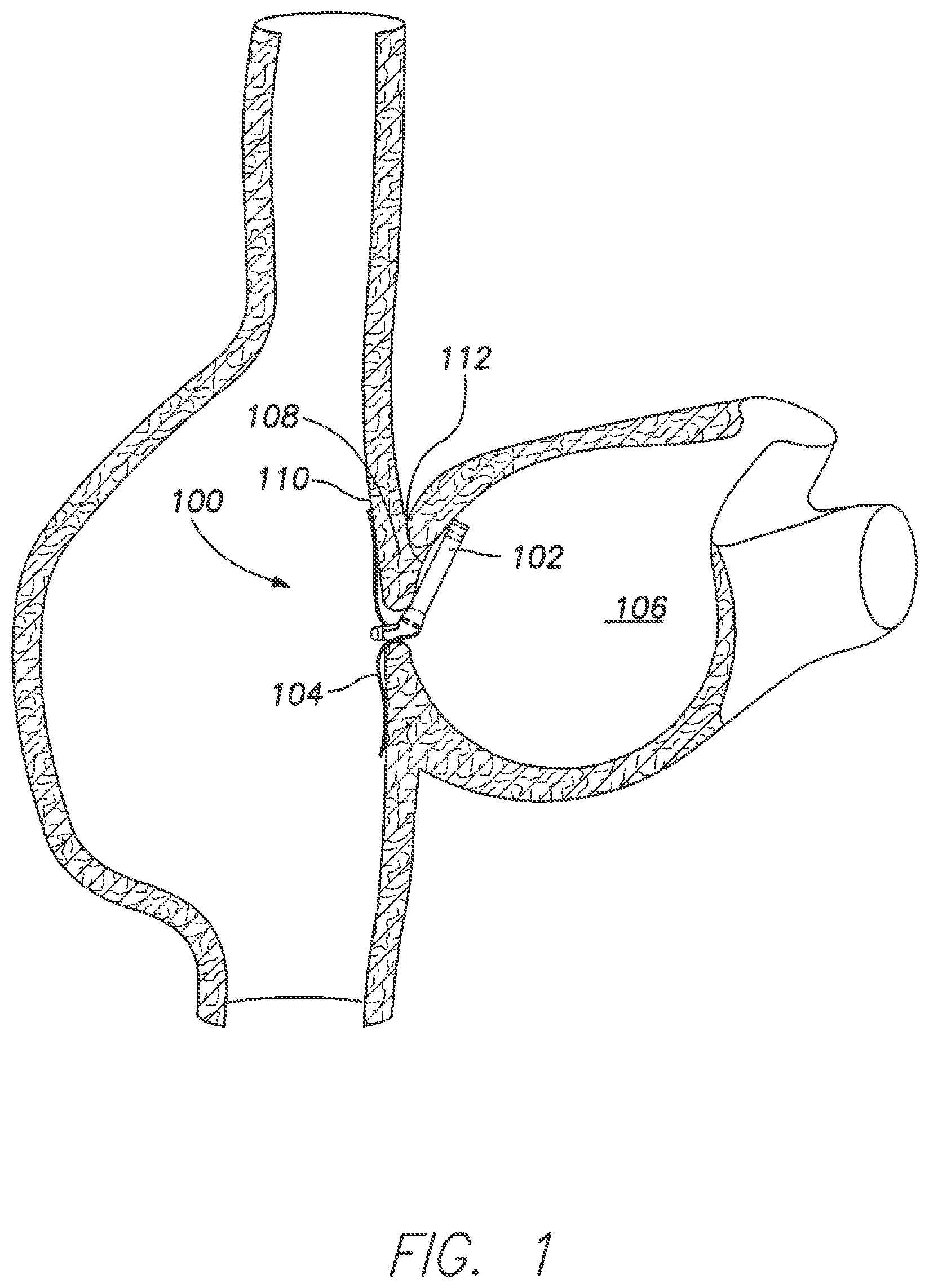 Patent US11793413 Figure 1 – Wireless MEMS left atrial pressure sensor