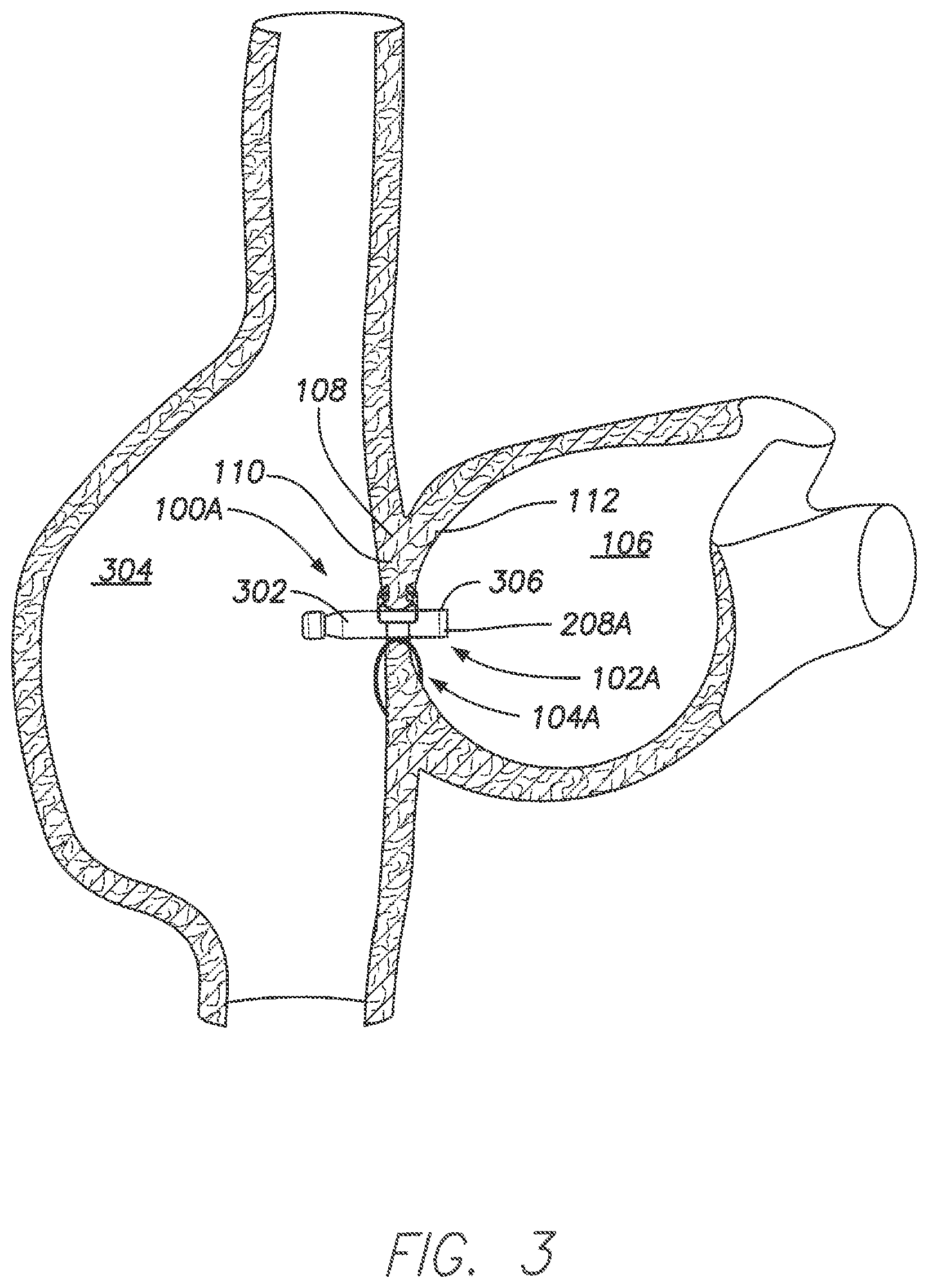 Patent US11793413 Figure 3 – Wireless MEMS left atrial pressure sensor