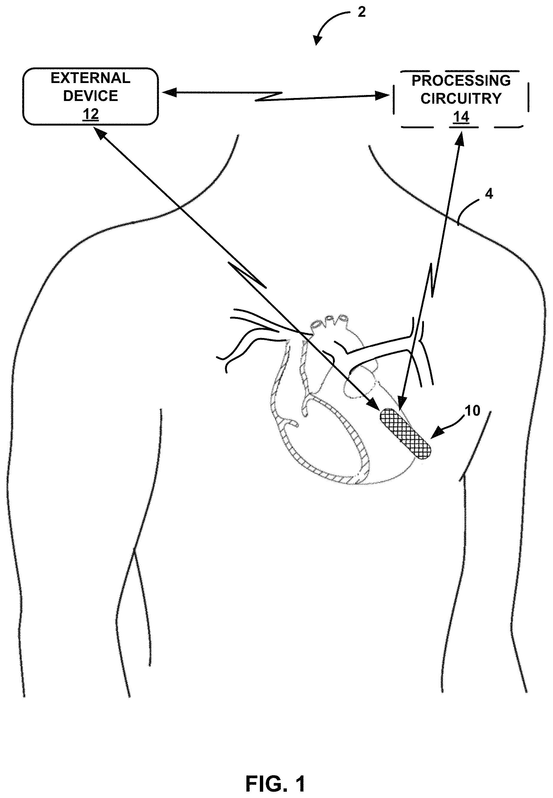 Patent US11793423 Figure 1 – Cough detection using frontal accelerometer