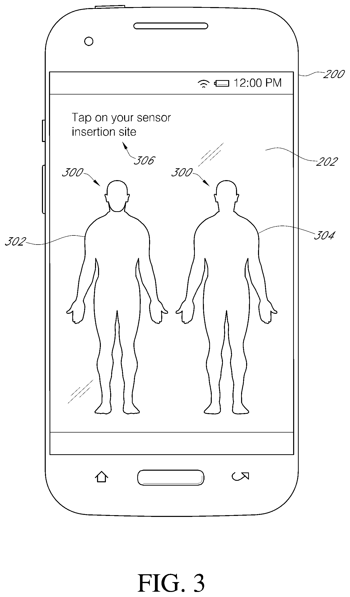 Patent US11793428 Figure 4 – Indicator and analytics for sensor insertion in a continuous analyte monitoring system and related methods