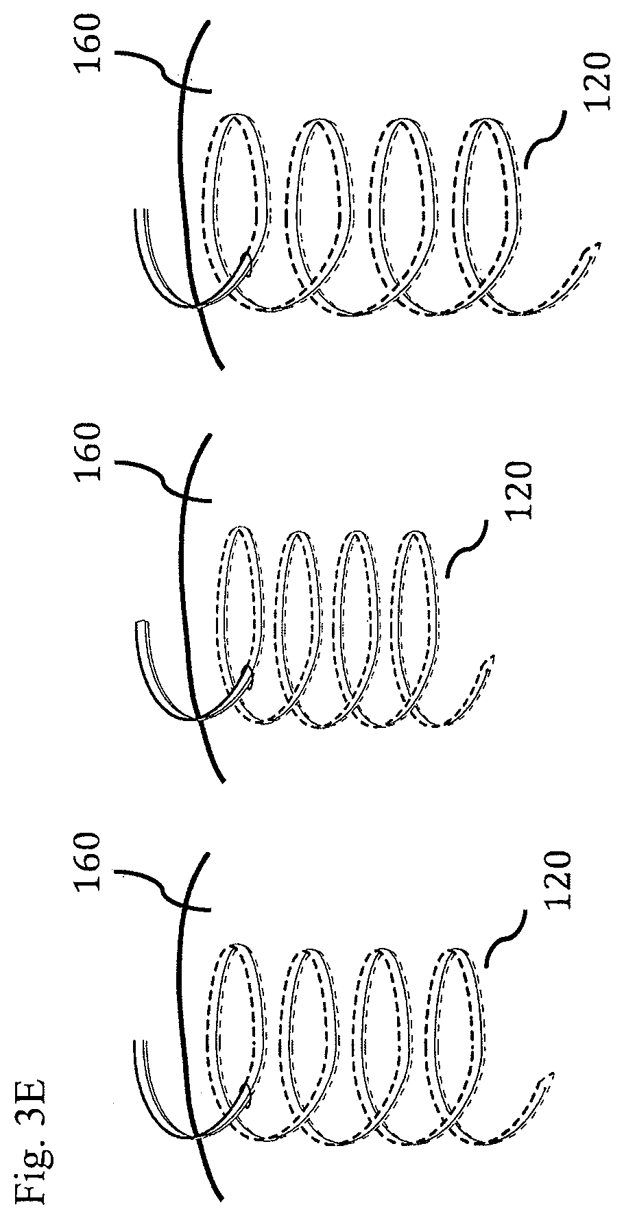 Patent US11793437 Figure 12 – Neural interface device and insertion tools