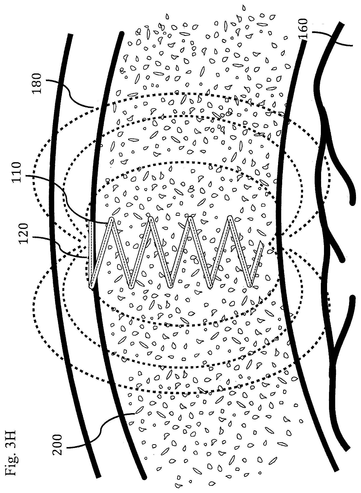 Patent US11793437 Figure 15 – Neural interface device and insertion tools