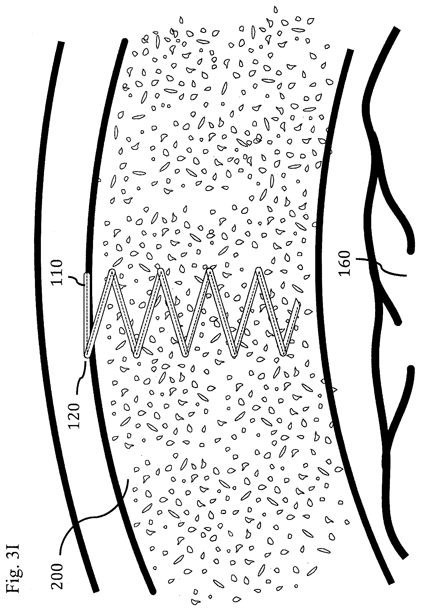 Patent US11793437 Figure 16 – Neural interface device and insertion tools