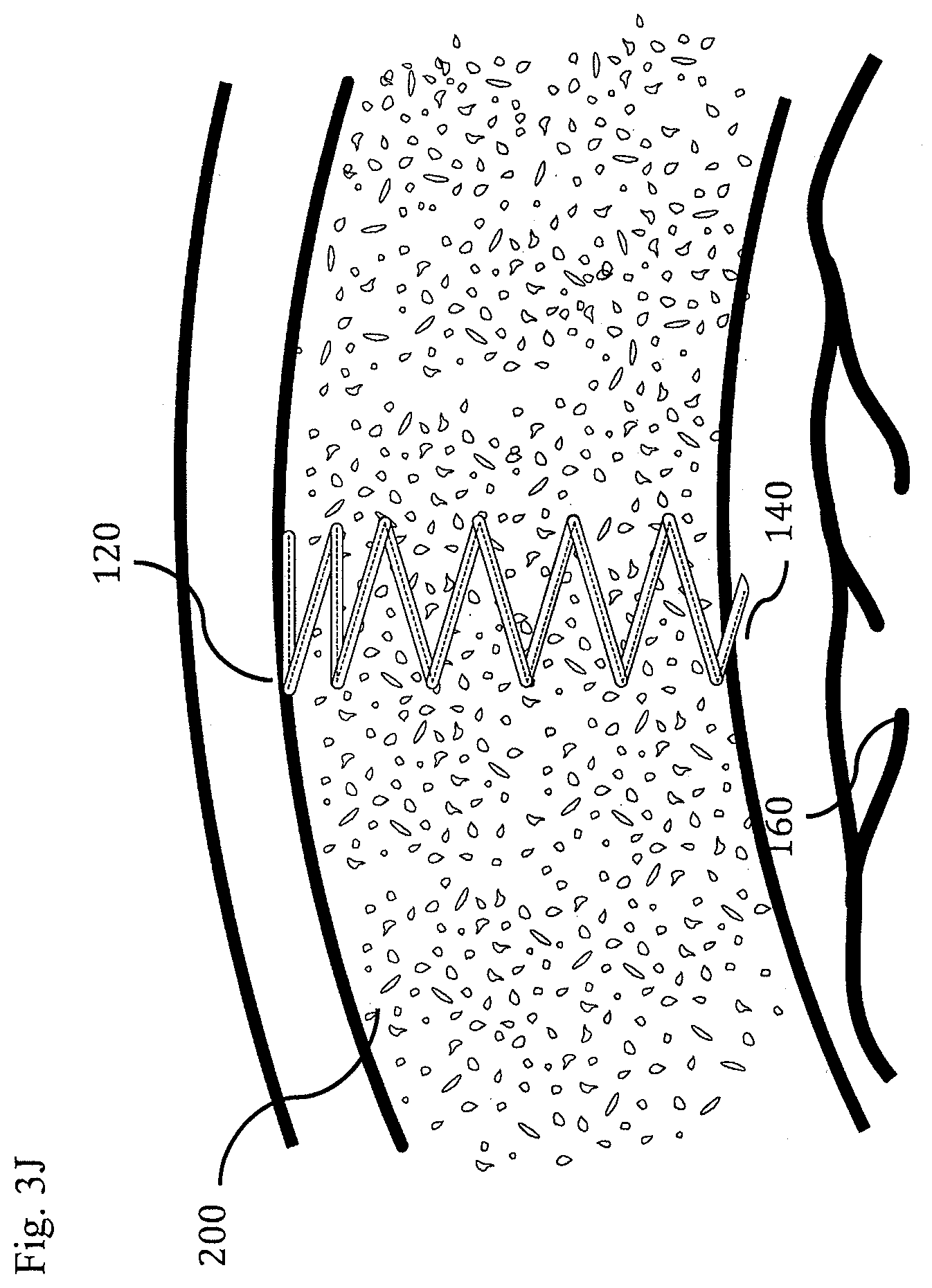 Patent US11793437 Figure 17 – Neural interface device and insertion tools