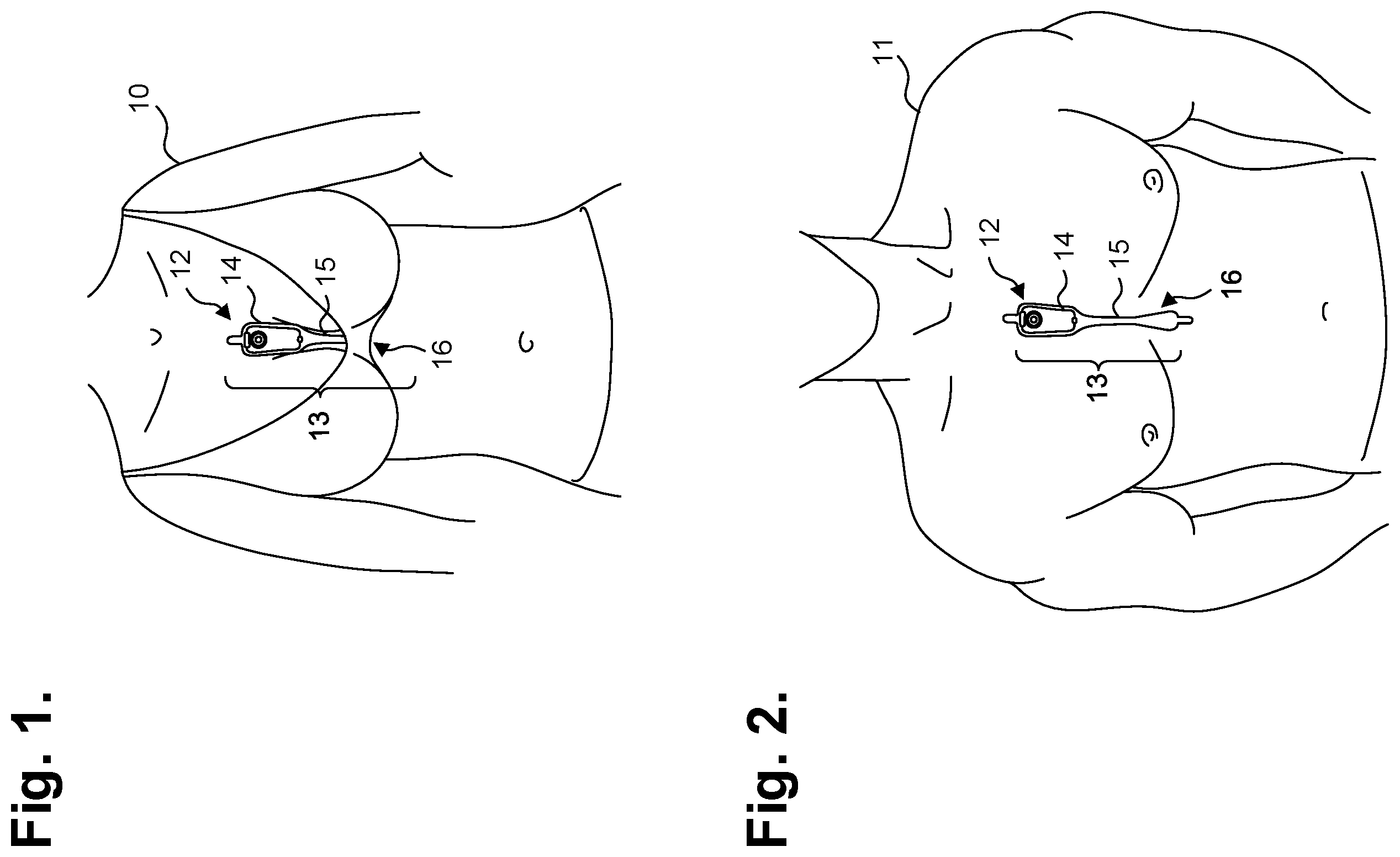Patent US11793441 — Electrocardiography patch — Figure 1