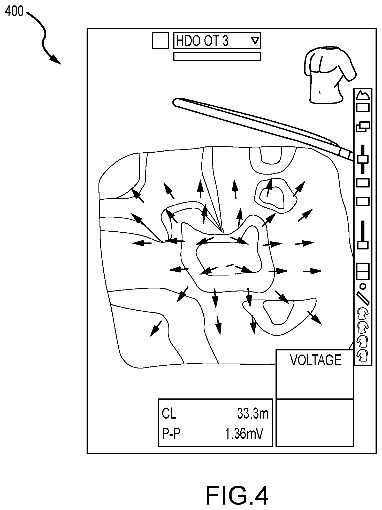 Patent US11793442 Figure 4 – System and method for mapping arrhythmic driver sites