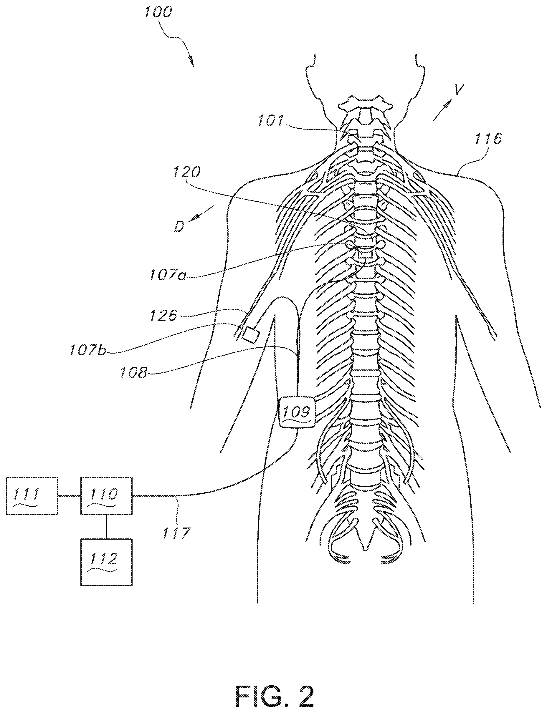 Patent US11793443 Figure 2 – Adjustable random electrical stimulation technologies