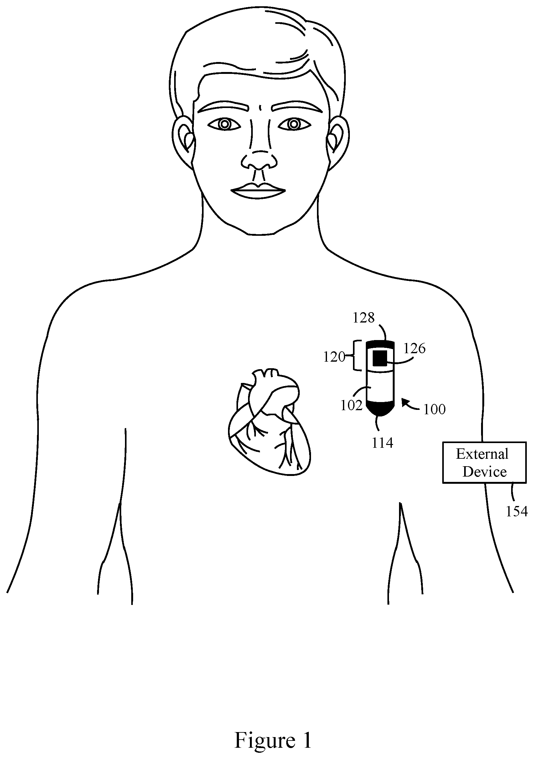 Patent US11793445 Figure 1 – Method and system to detect P-waves in cardiac arrhythmic patterns