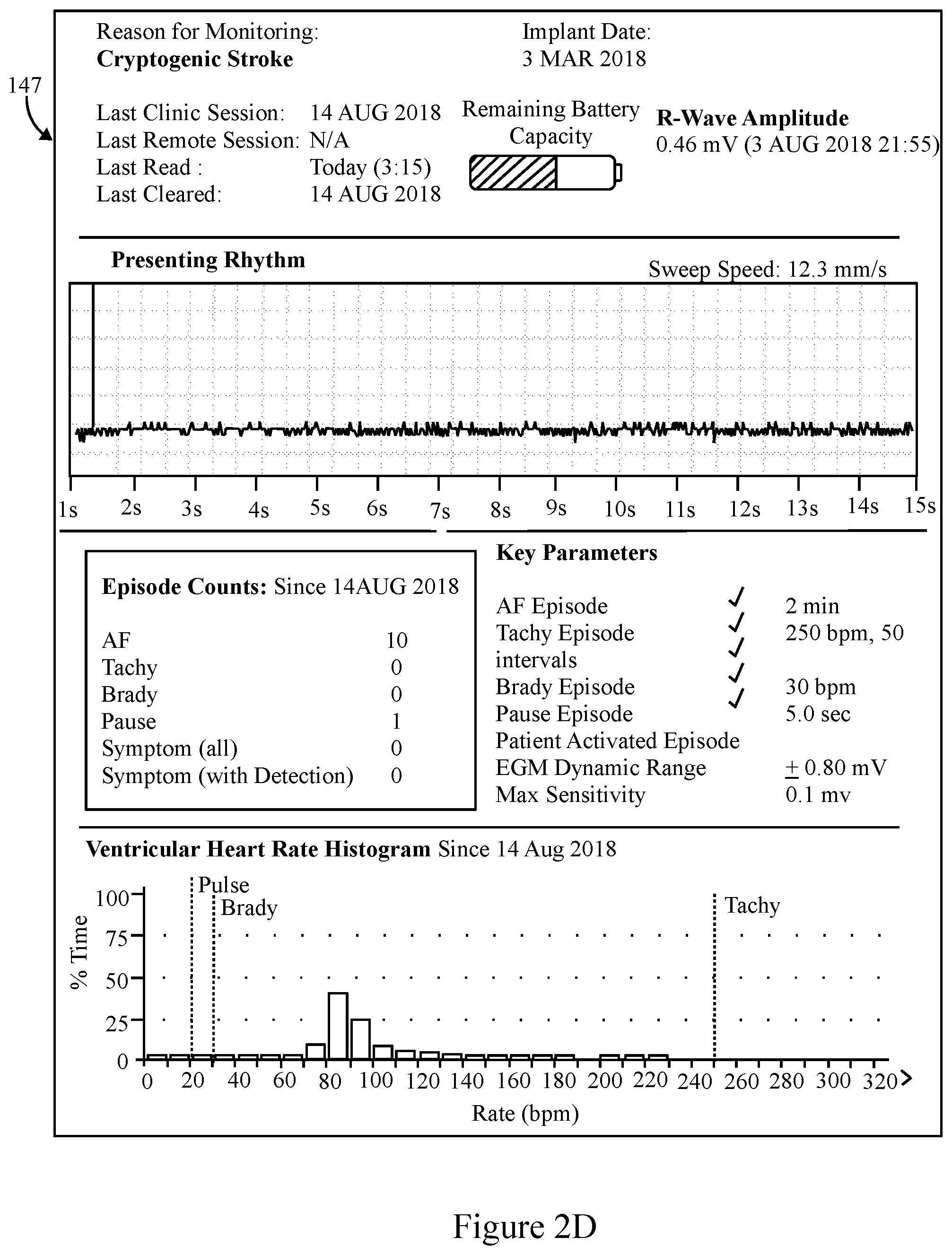 Patent US11793445 Figure 4 – Method and system to detect P-waves in cardiac arrhythmic patterns