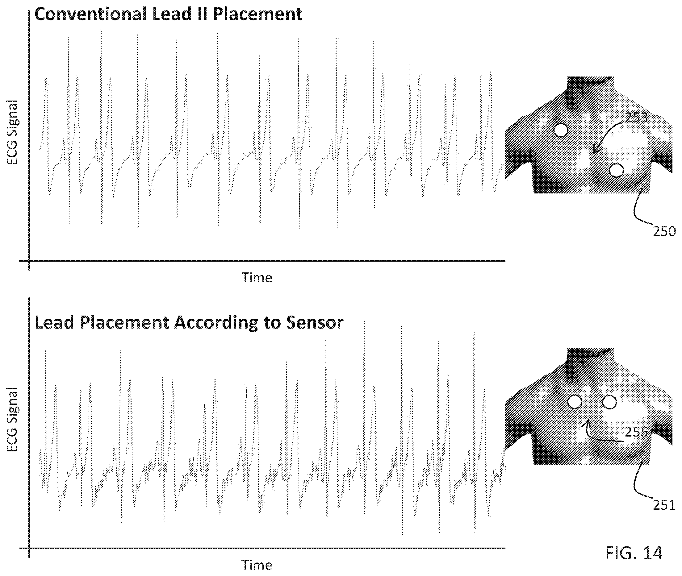 Patent US11793460 Figure 14 – Body-worn sensor for characterizing patients with heart failure