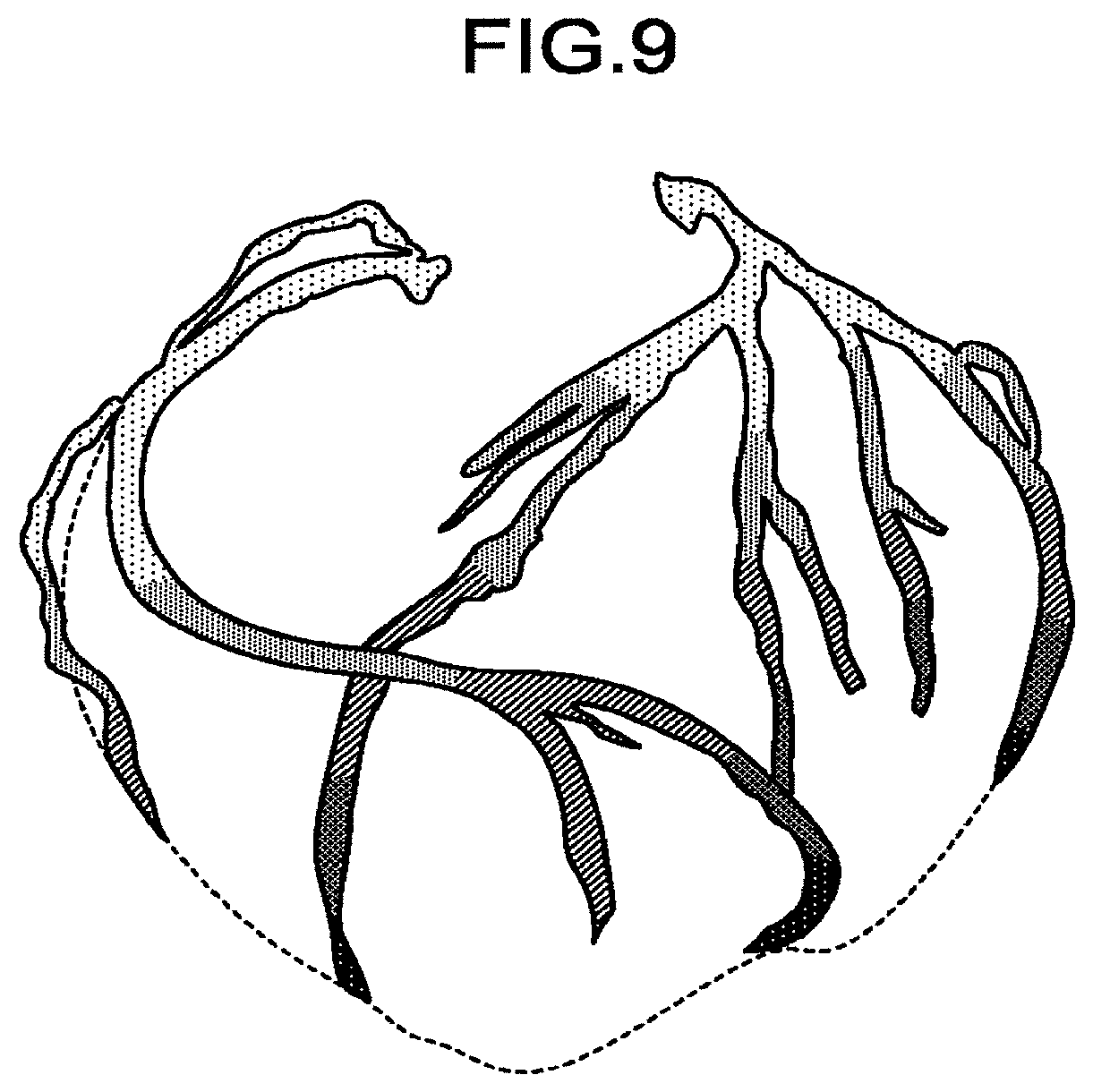 Patent US11793478 Figure 7 – Medical image processing apparatus, medical image processing method, and X-ray diagnostic apparatus