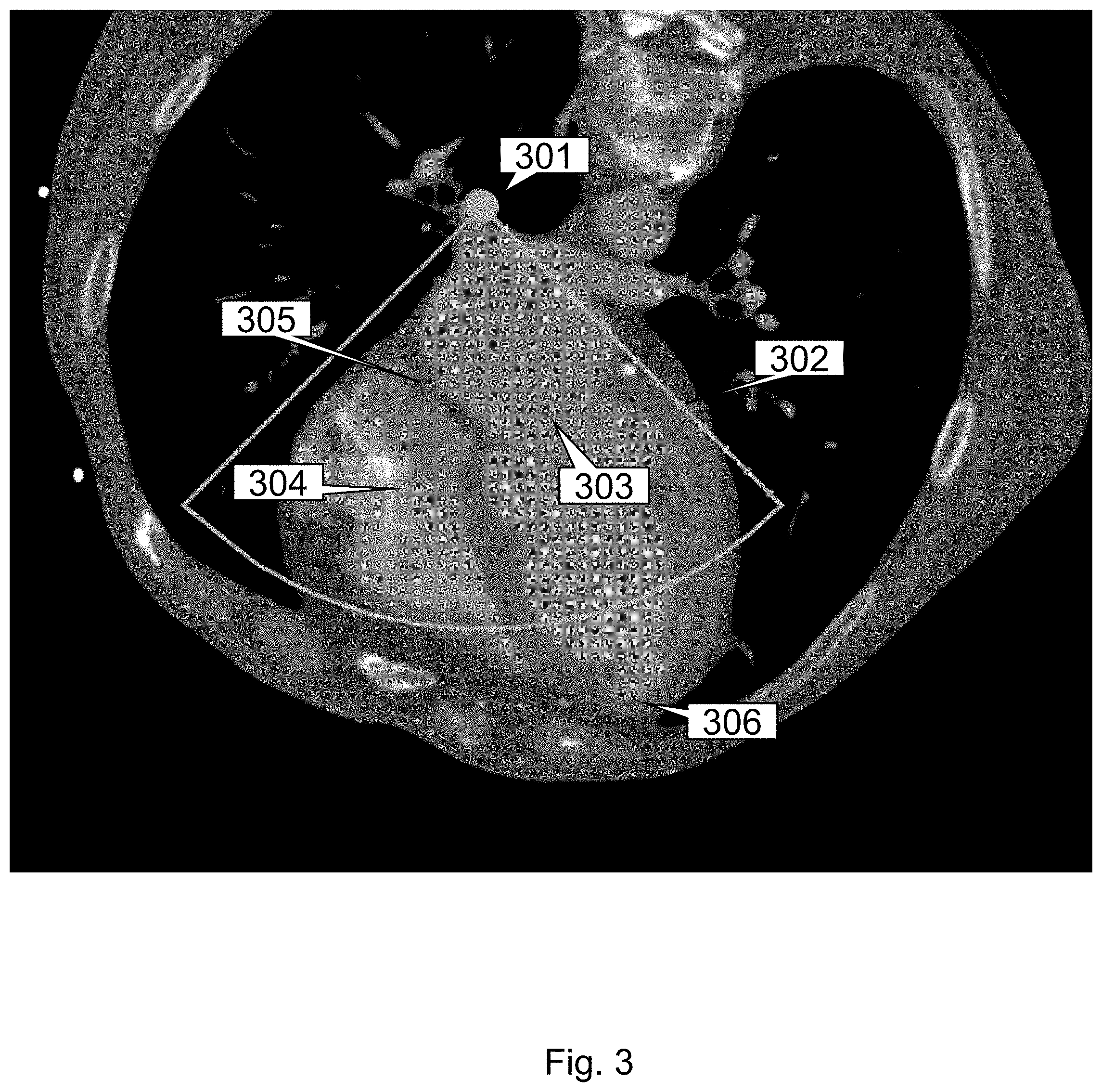 Patent US11793484 Figure 3 – Method, device and system for intracavity probe procedure planning