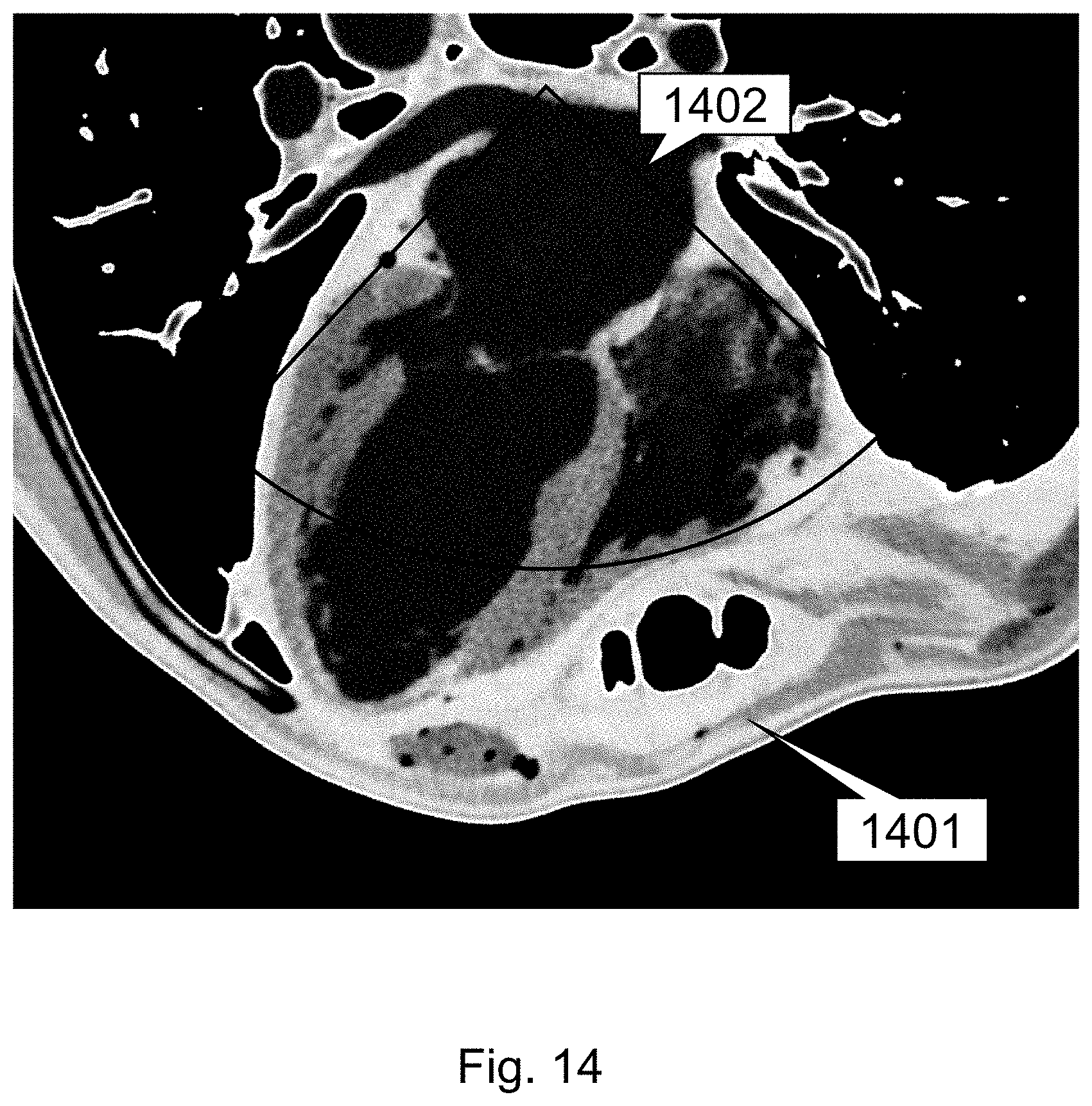 Patent US11793484 Figure 14 – Method, device and system for intracavity probe procedure planning