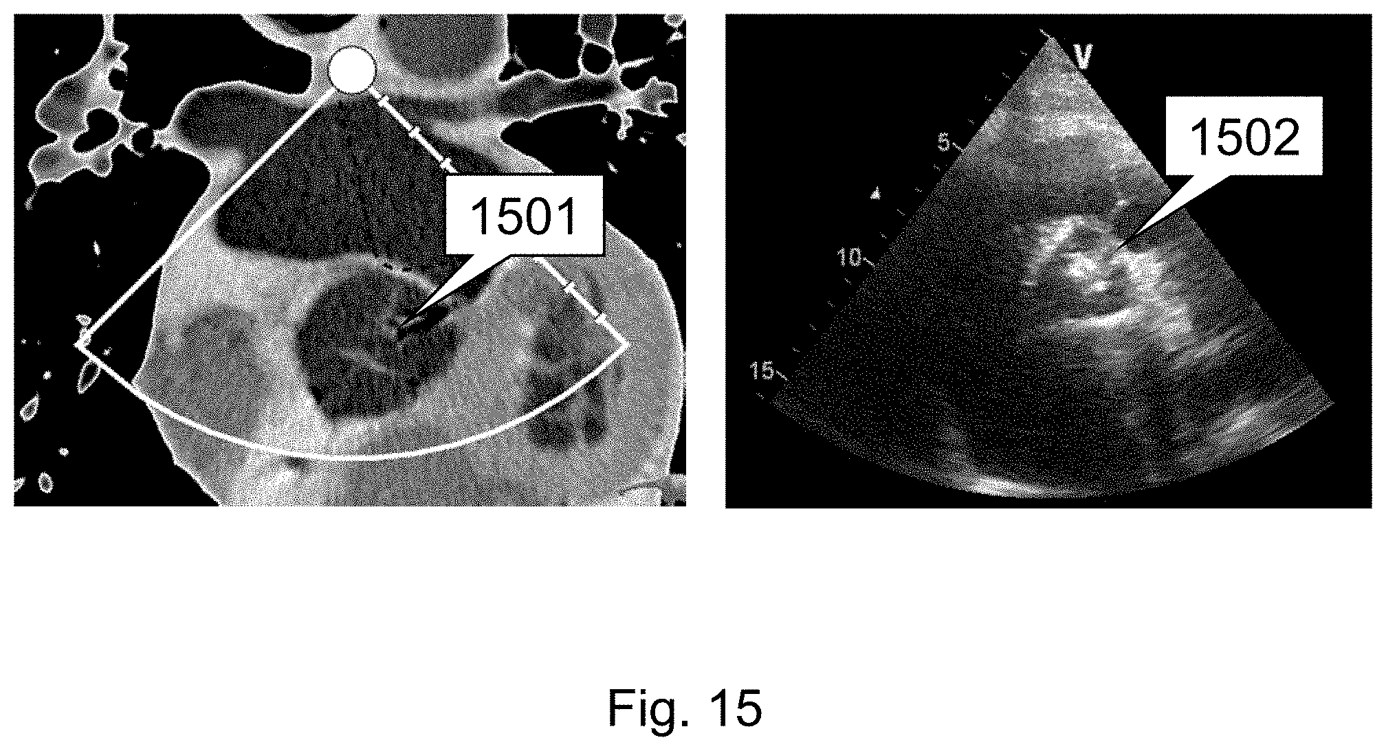 Patent US11793484 Figure 15 – Method, device and system for intracavity probe procedure planning