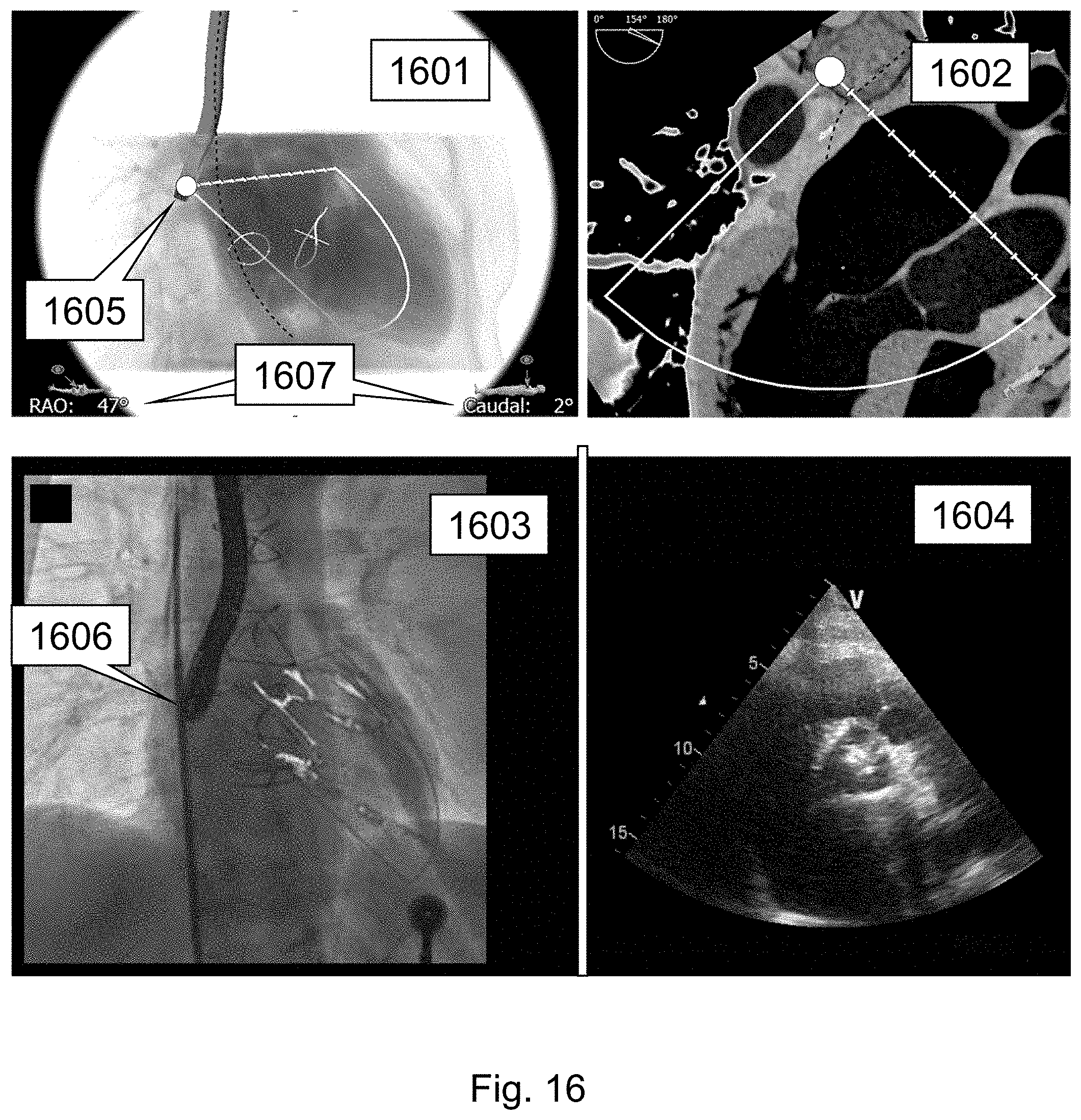Patent US11793484 Figure 16 – Method, device and system for intracavity probe procedure planning