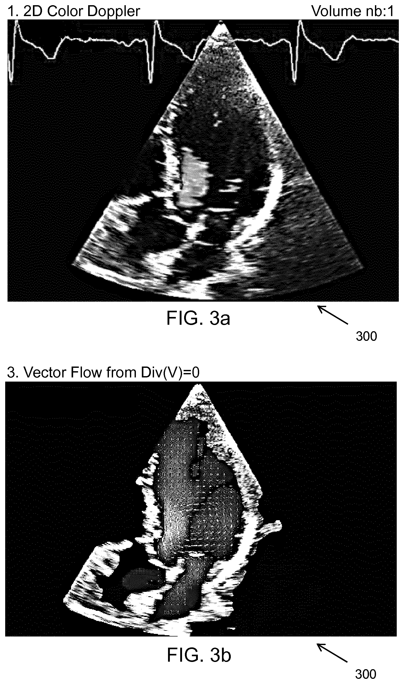 Patent US11793492 Figure 3 – Methods and systems for performing color doppler ultrasound imaging