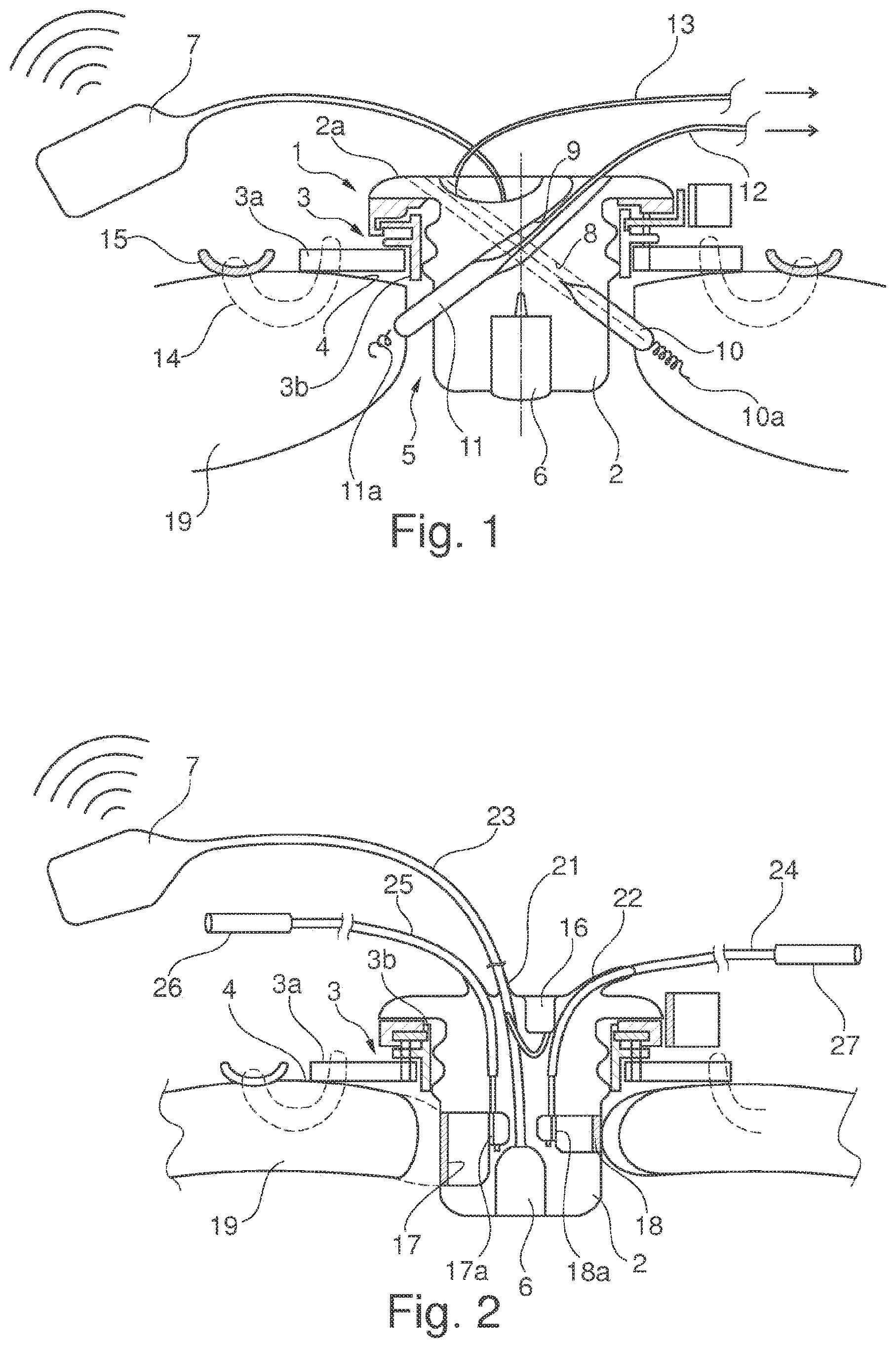 Patent US11793502 Figure 1 – Closing device for an opening in the heart of a patient