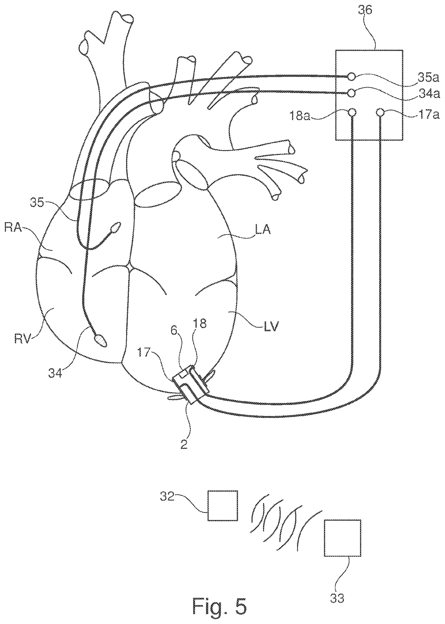 Patent US11793502 Figure 3 – Closing device for an opening in the heart of a patient