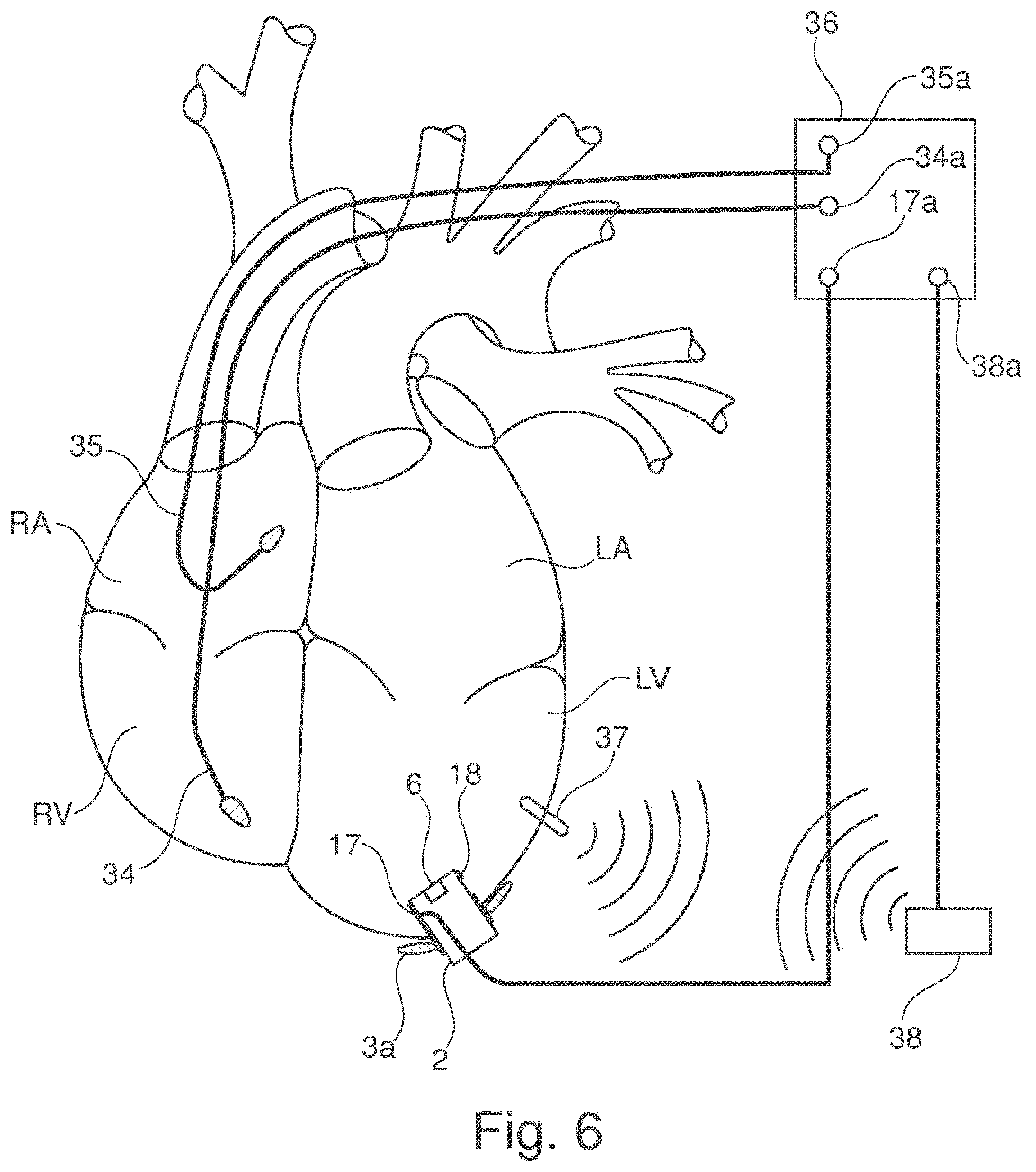 Patent US11793502 Figure 4 – Closing device for an opening in the heart of a patient
