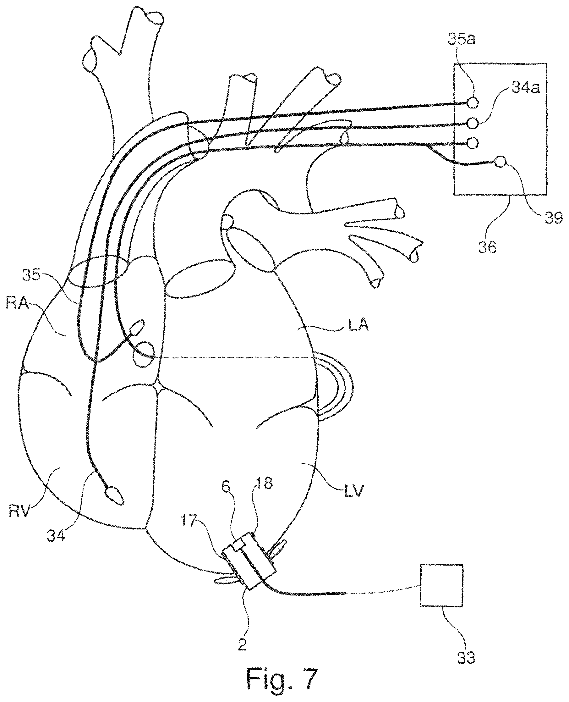 Patent US11793502 Figure 5 – Closing device for an opening in the heart of a patient