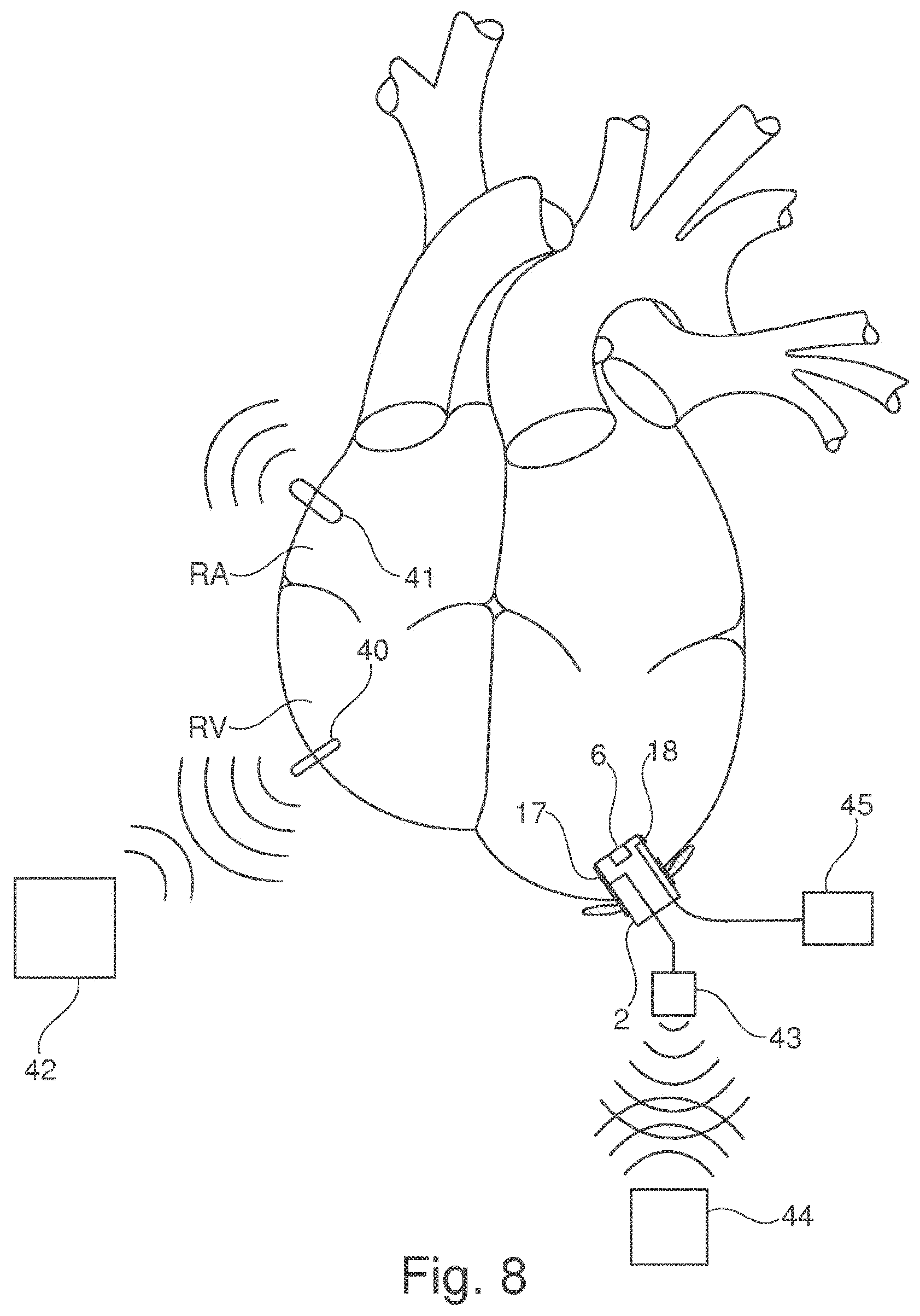 Patent US11793502 Figure 6 – Closing device for an opening in the heart of a patient