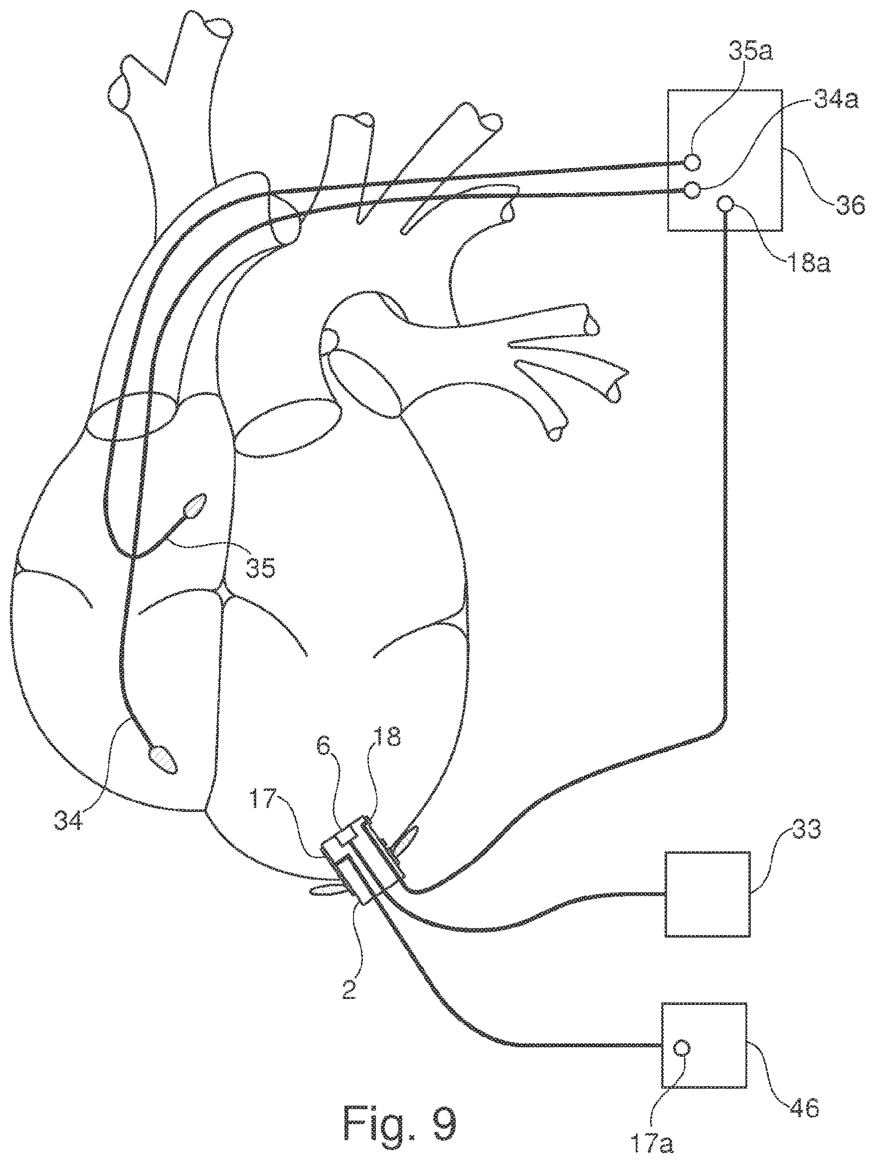 Patent US11793502 Figure 7 – Closing device for an opening in the heart of a patient