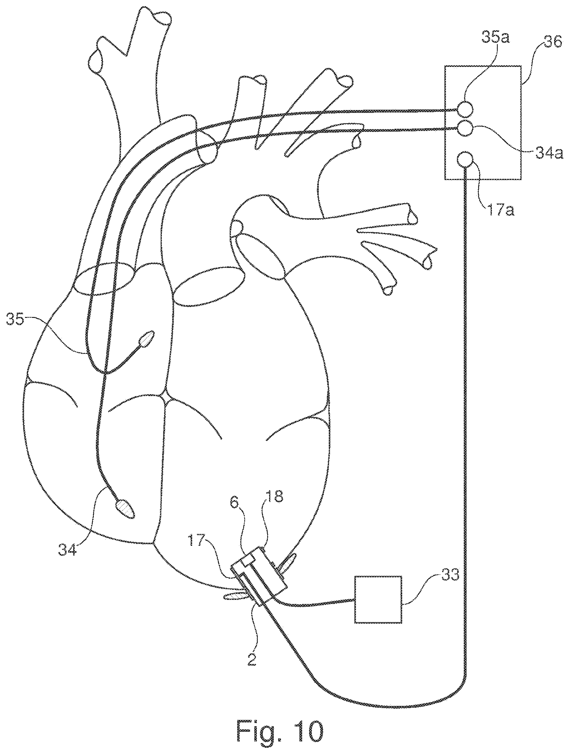 Patent US11793502 Figure 8 – Closing device for an opening in the heart of a patient