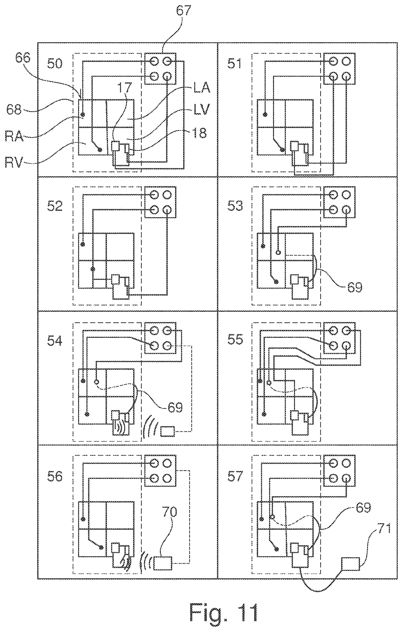 Patent US11793502 Figure 9 – Closing device for an opening in the heart of a patient