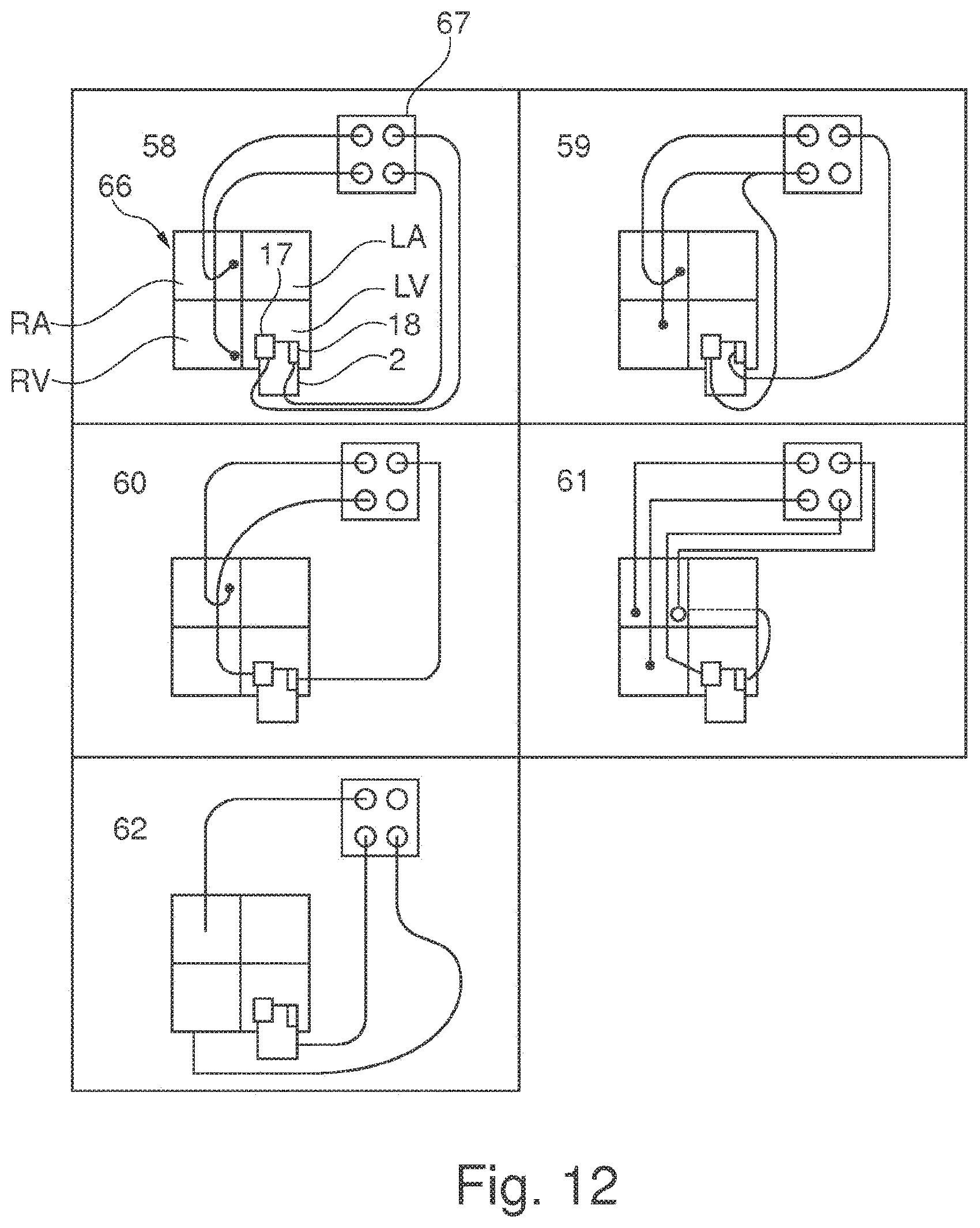 Patent US11793502 Figure 10 – Closing device for an opening in the heart of a patient