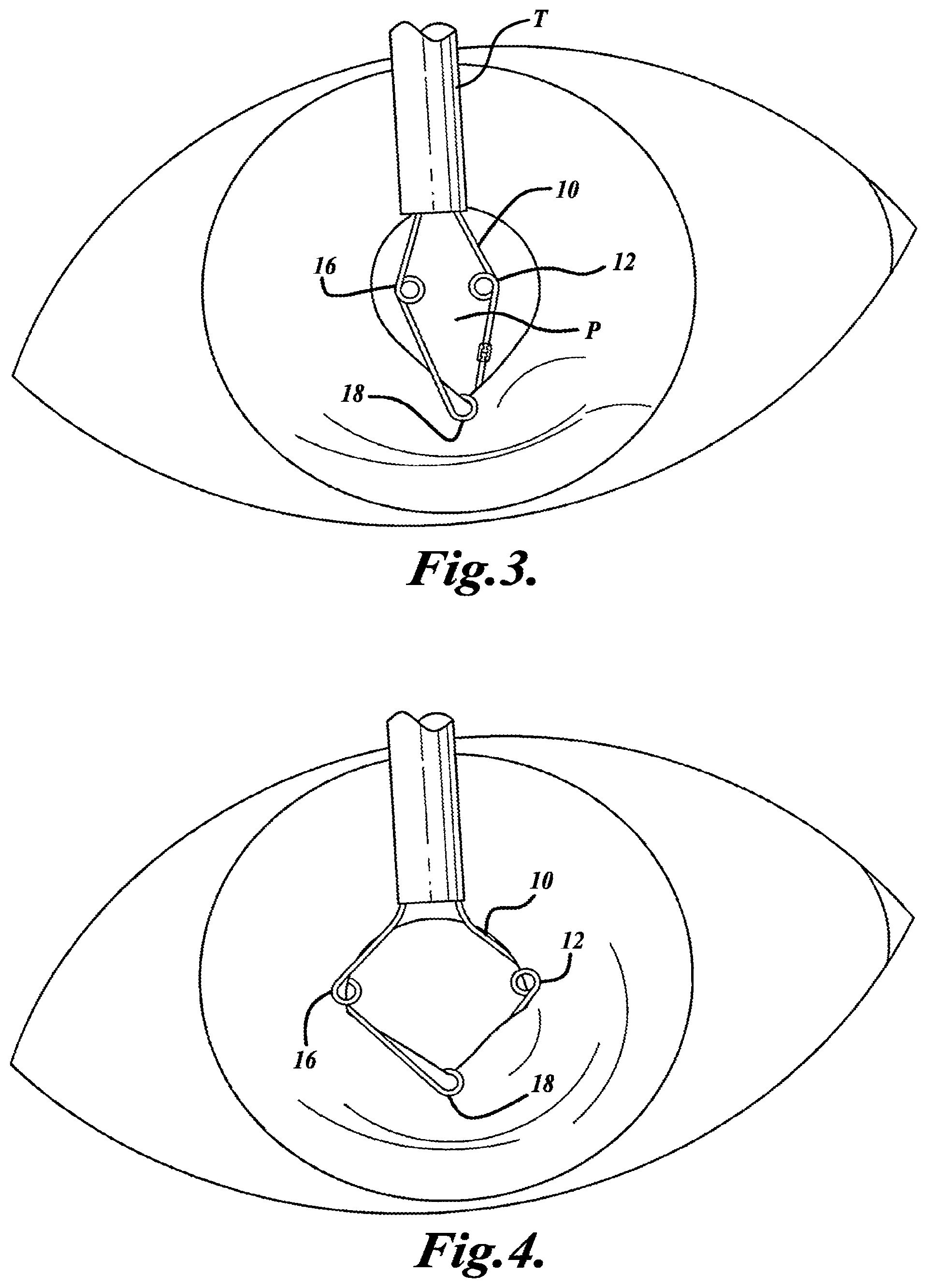Patent US11793503 Figure 2 – Expansion ring for eyeball tissue