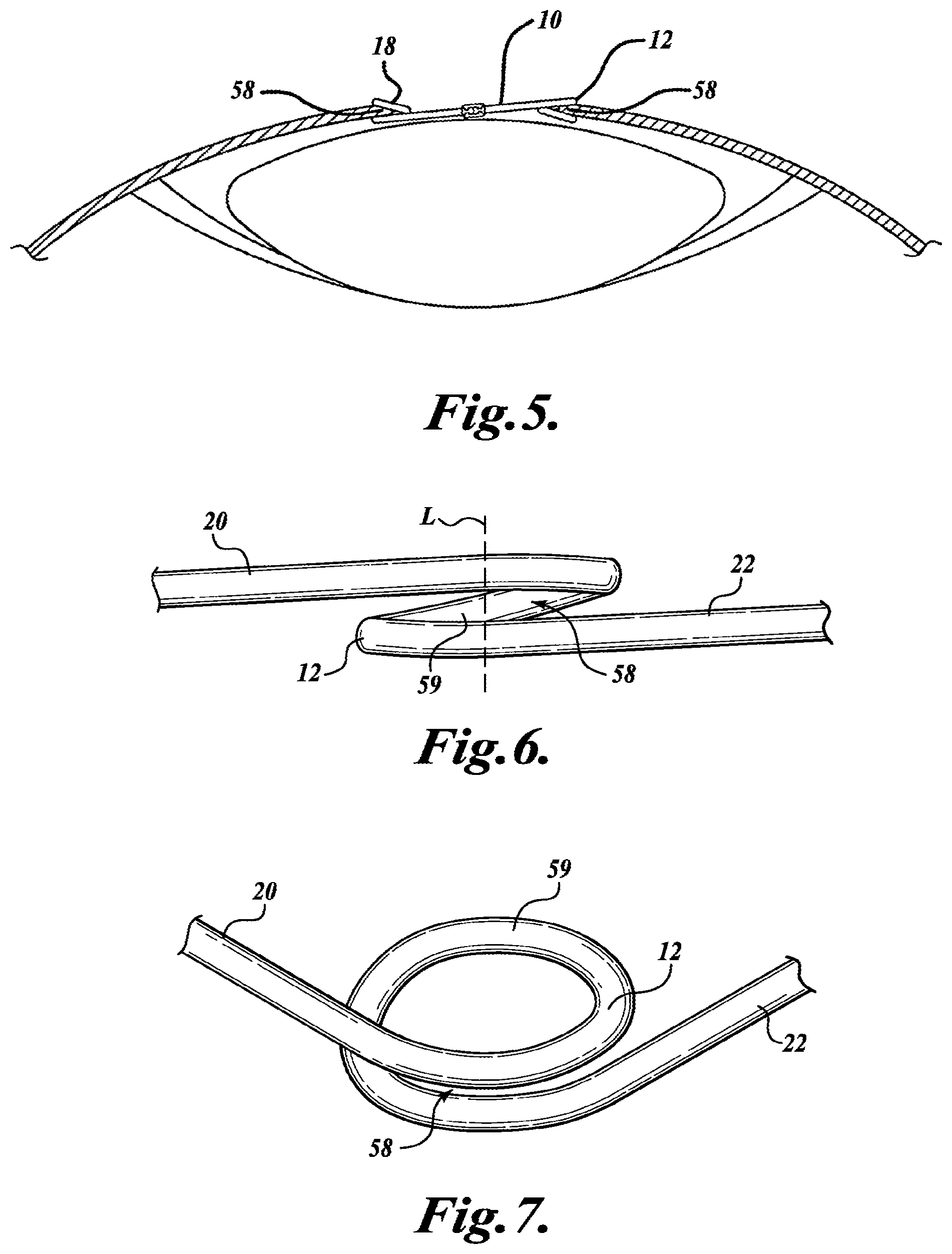 Patent US11793503 Figure 3 – Expansion ring for eyeball tissue