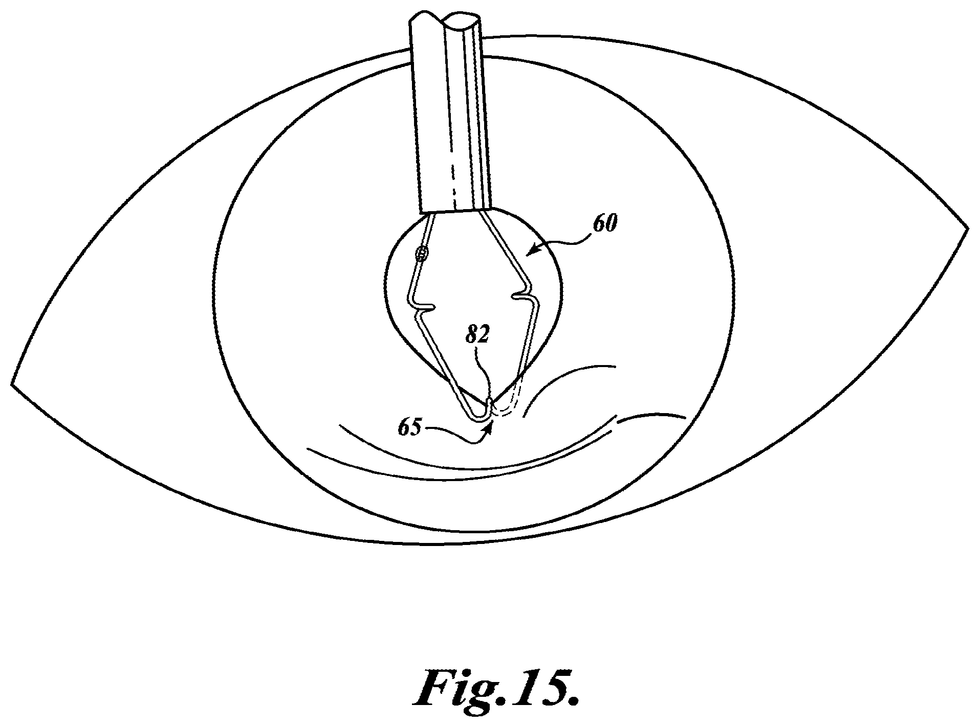 Patent US11793503 Figure 10 – Expansion ring for eyeball tissue