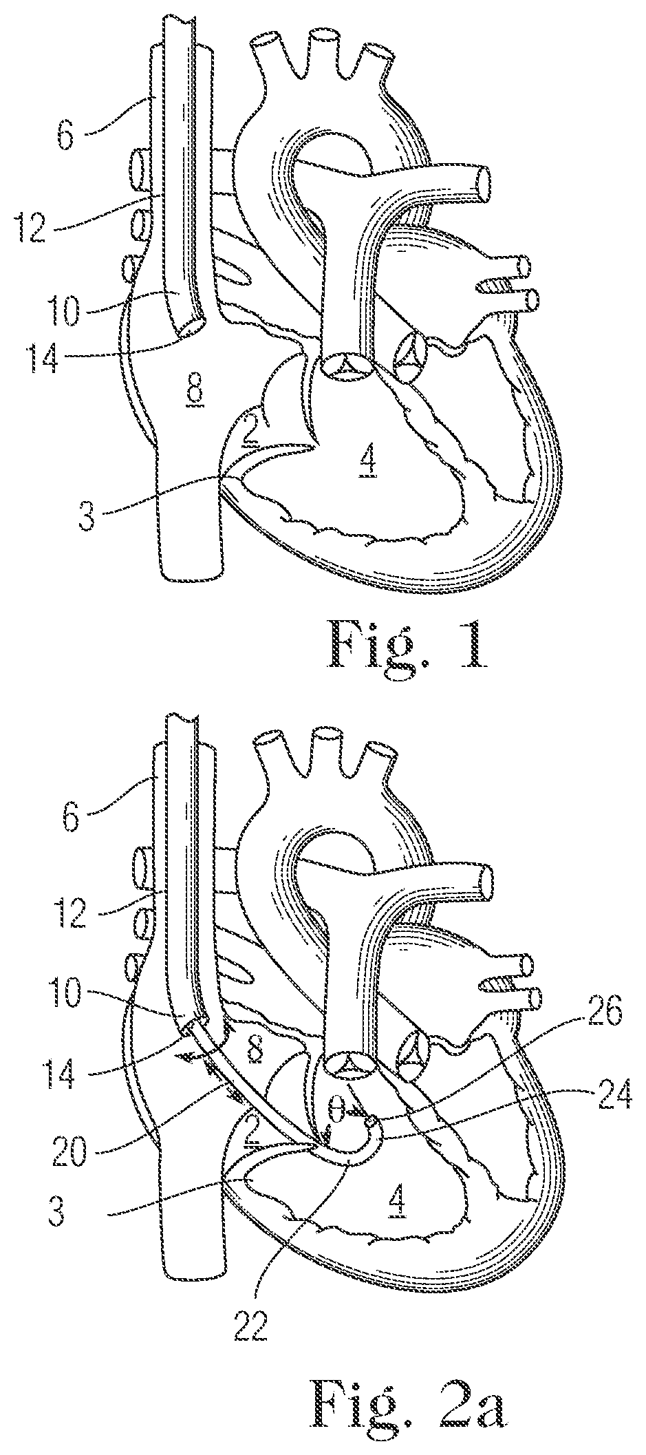 Patent US11793505 Figure 1 – Devices and methods for percutaneous tricuspid valve repair