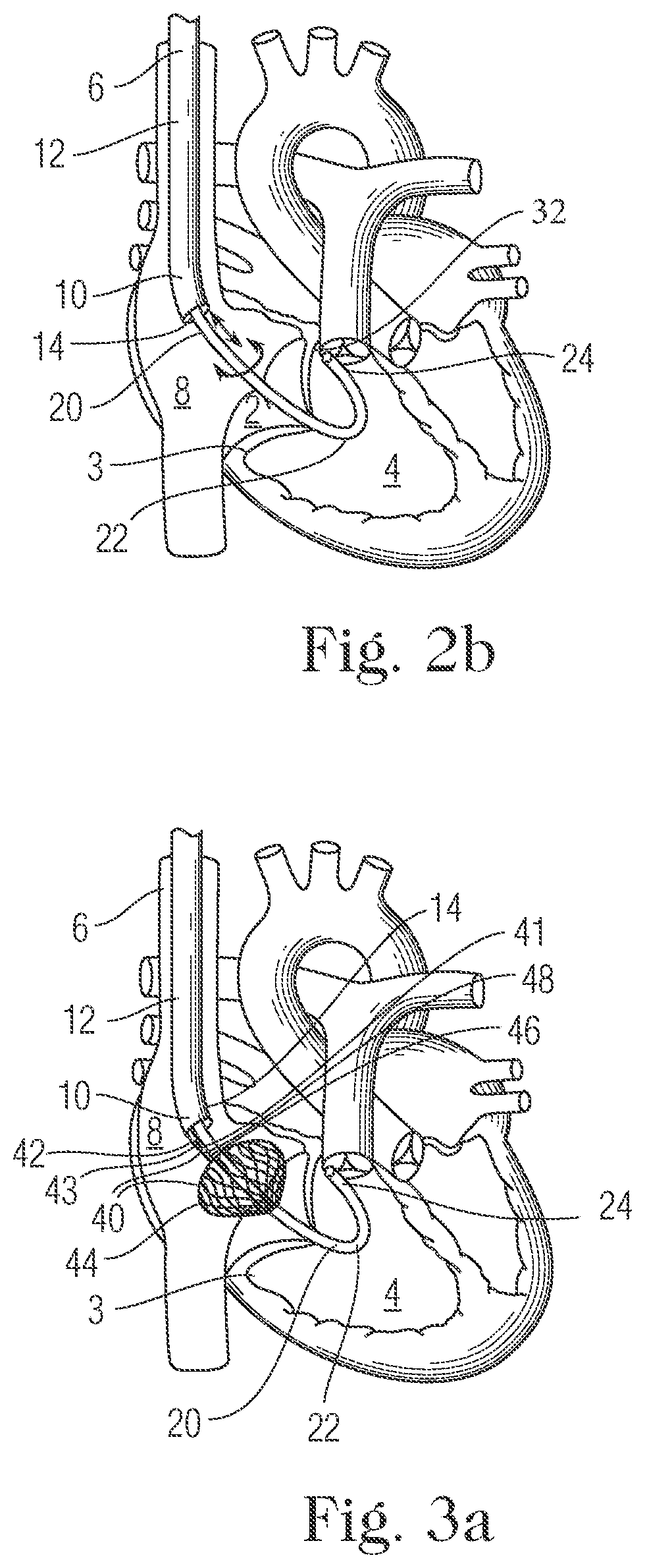 Patent US11793505 Figure 2 – Devices and methods for percutaneous tricuspid valve repair