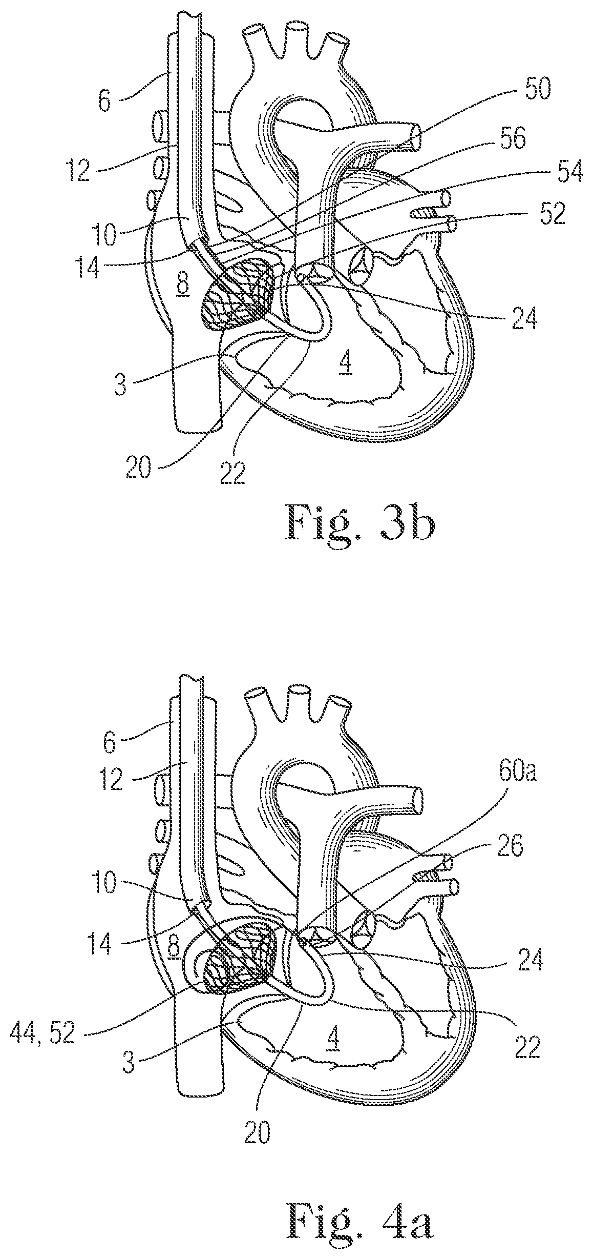 Patent US11793505 Figure 3 – Devices and methods for percutaneous tricuspid valve repair