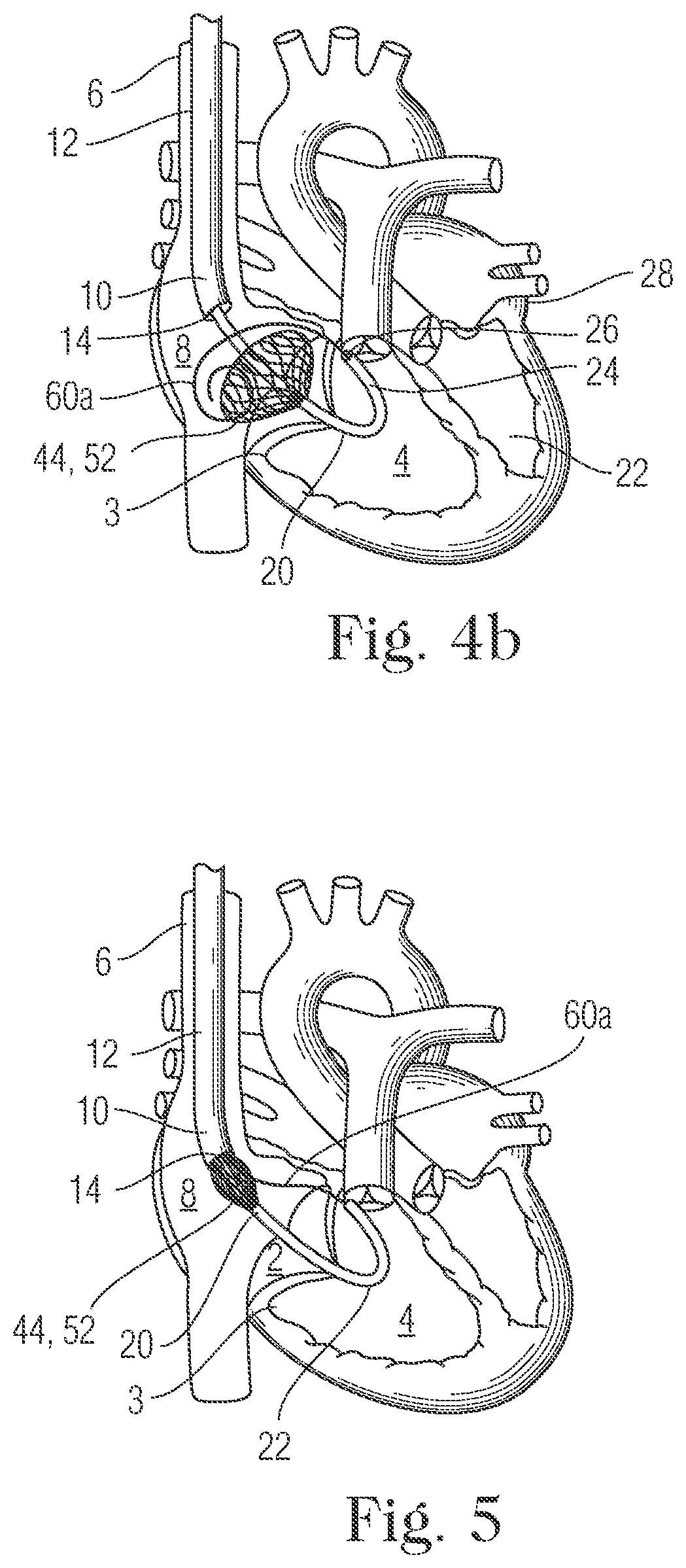 Patent US11793505 Figure 4 – Devices and methods for percutaneous tricuspid valve repair