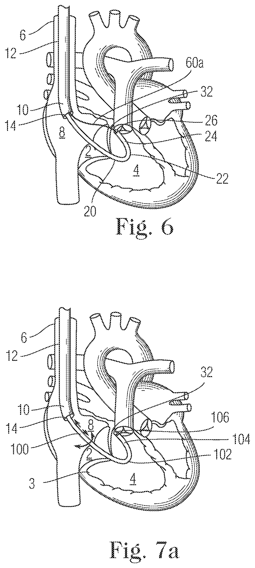 Patent US11793505 Figure 5 – Devices and methods for percutaneous tricuspid valve repair