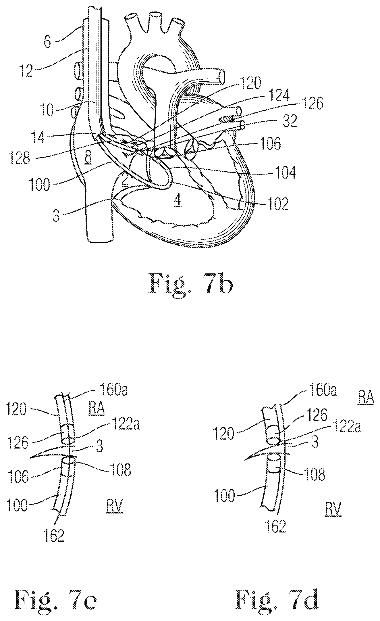 Patent US11793505 Figure 6 – Devices and methods for percutaneous tricuspid valve repair